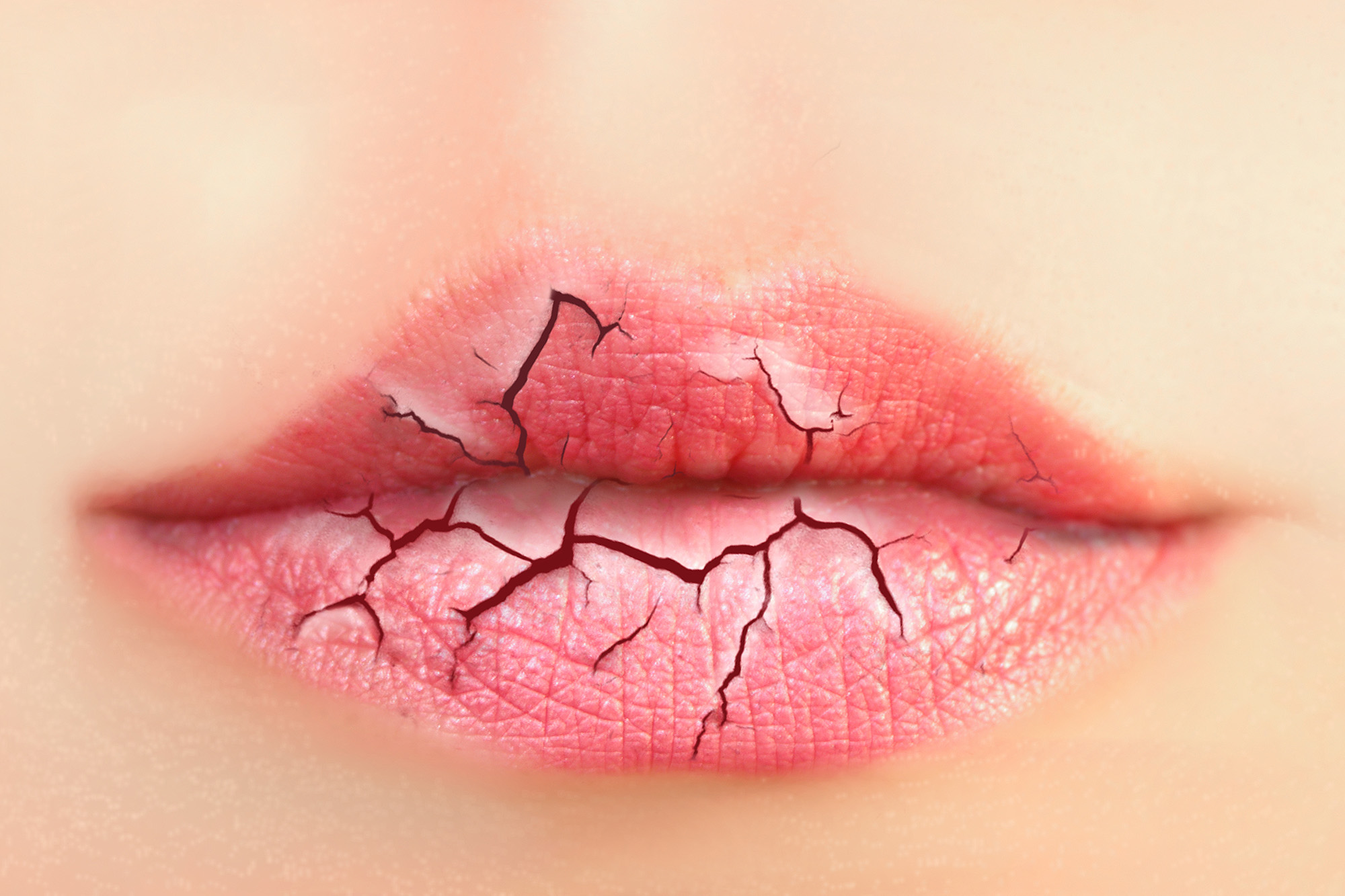 cracking-lips