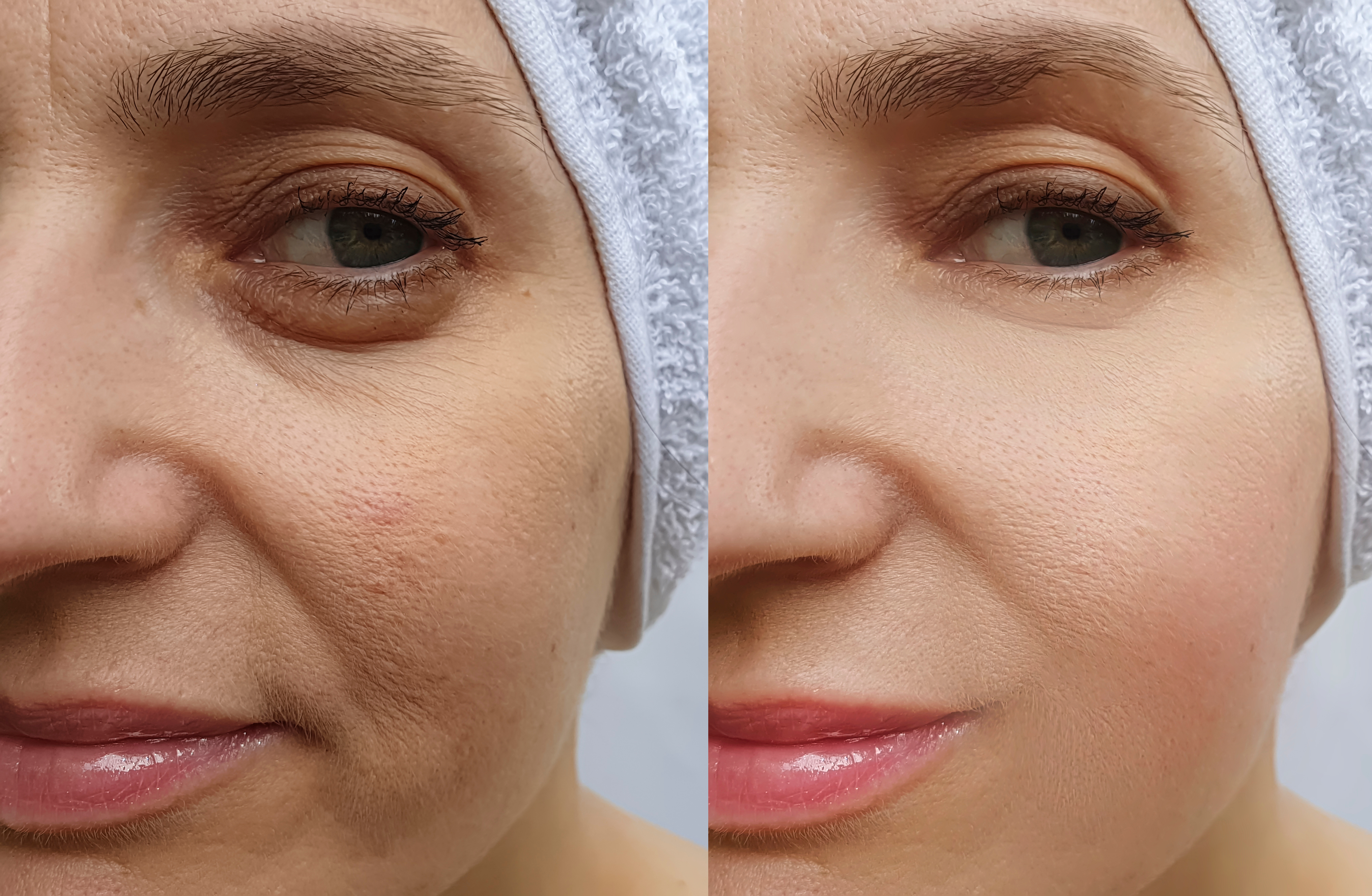 Tired Eyes Before and After