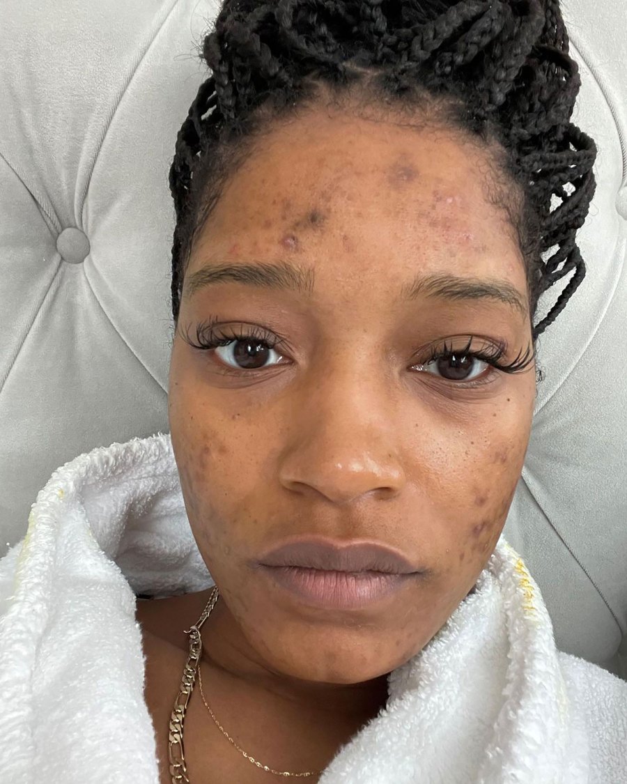 Keke Palmer Opens Up About Her Acne: 'My Skin Has Made Me Sad Many Nights'