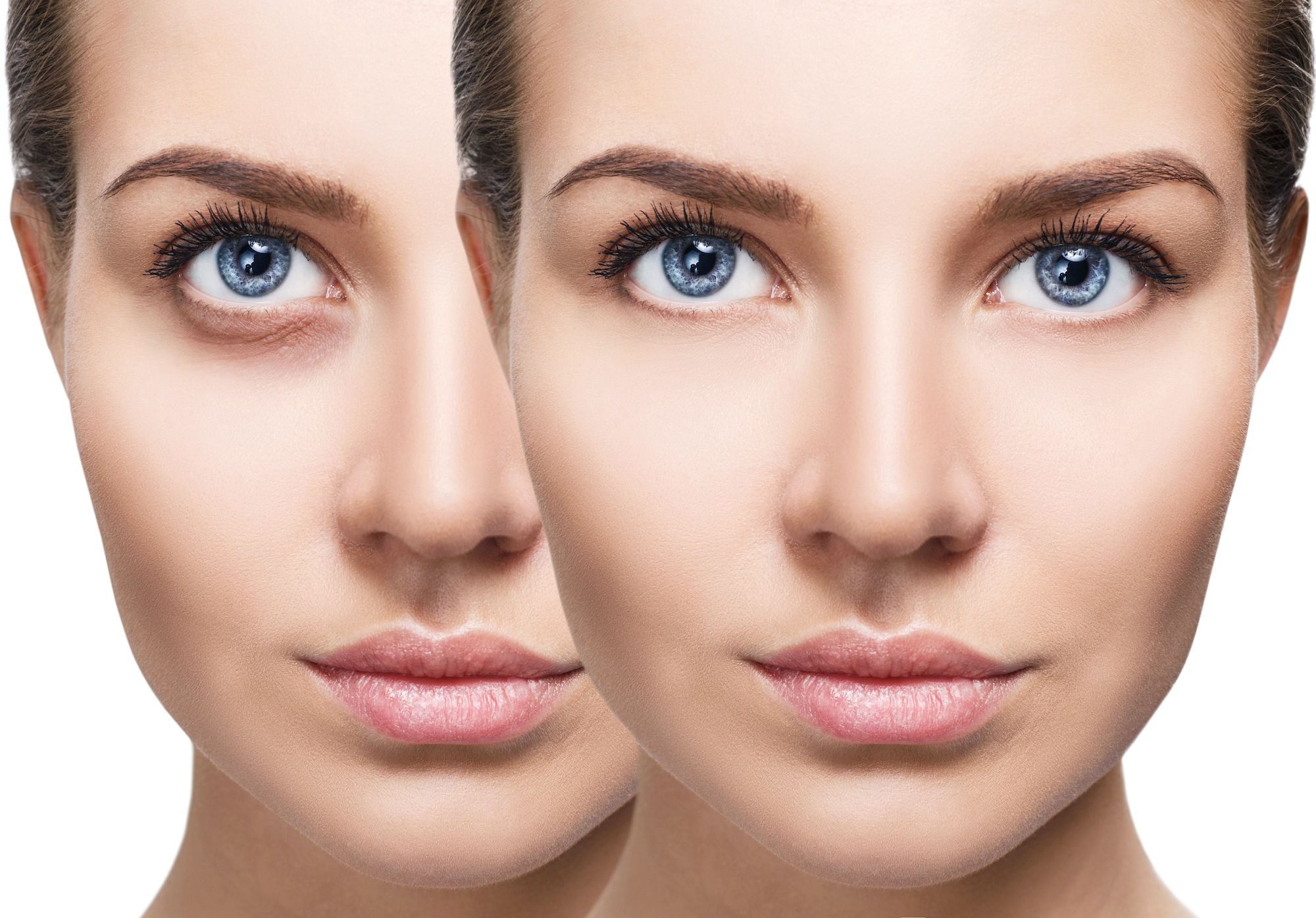 Dark-Circles-Before-After-Stock-Photo