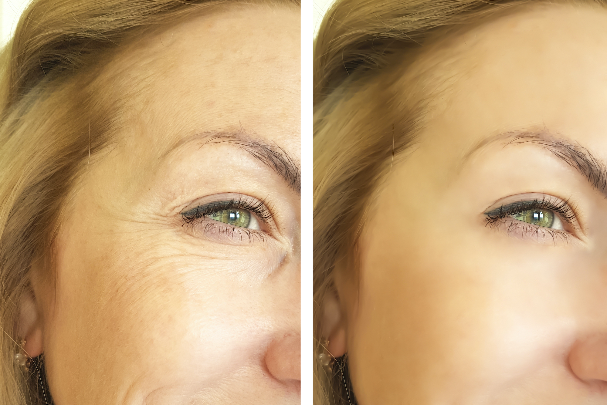 Wrinkle-Before-After-Stock-Photo