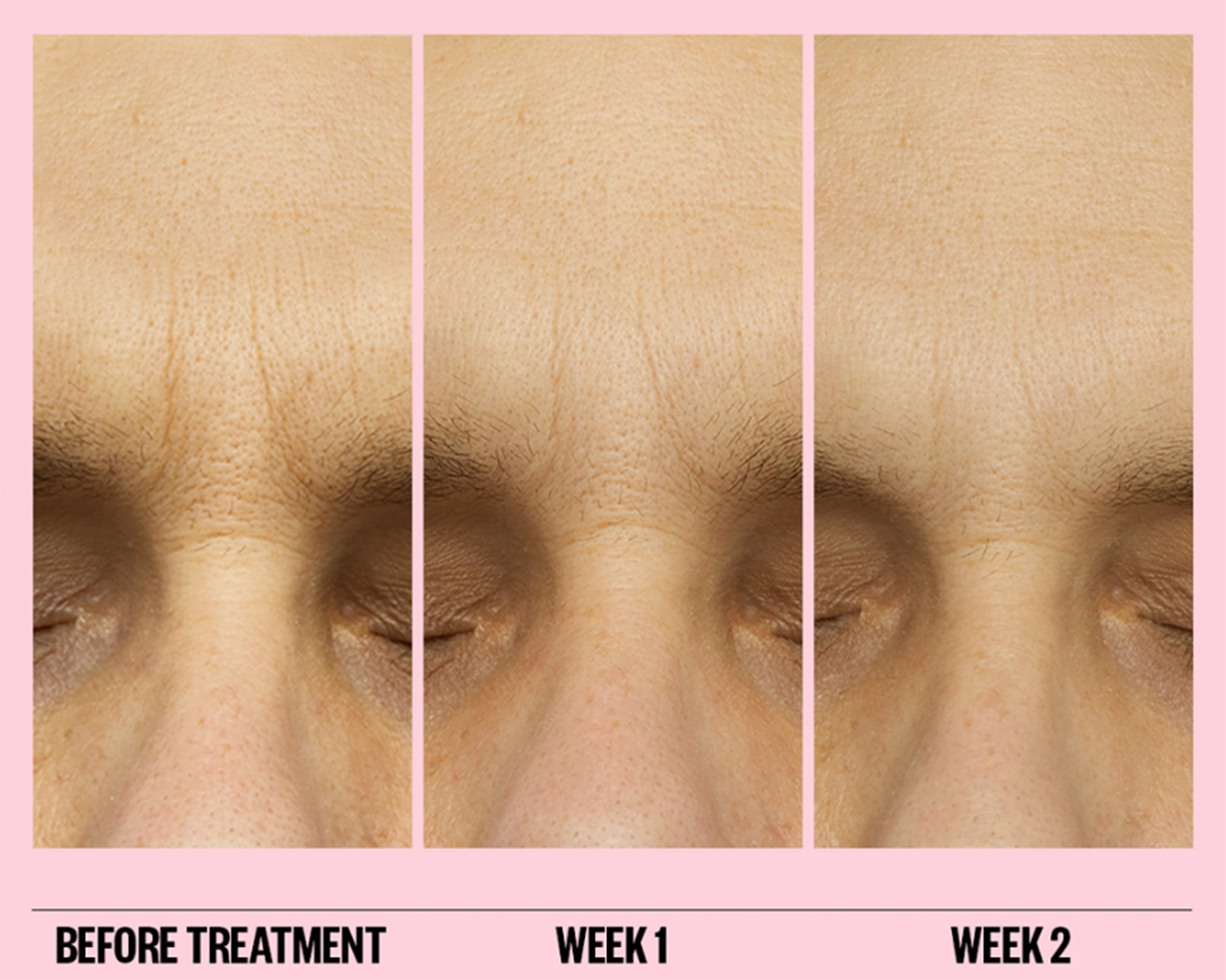 peace-out-microneedling-patches-wrinkle-before-after