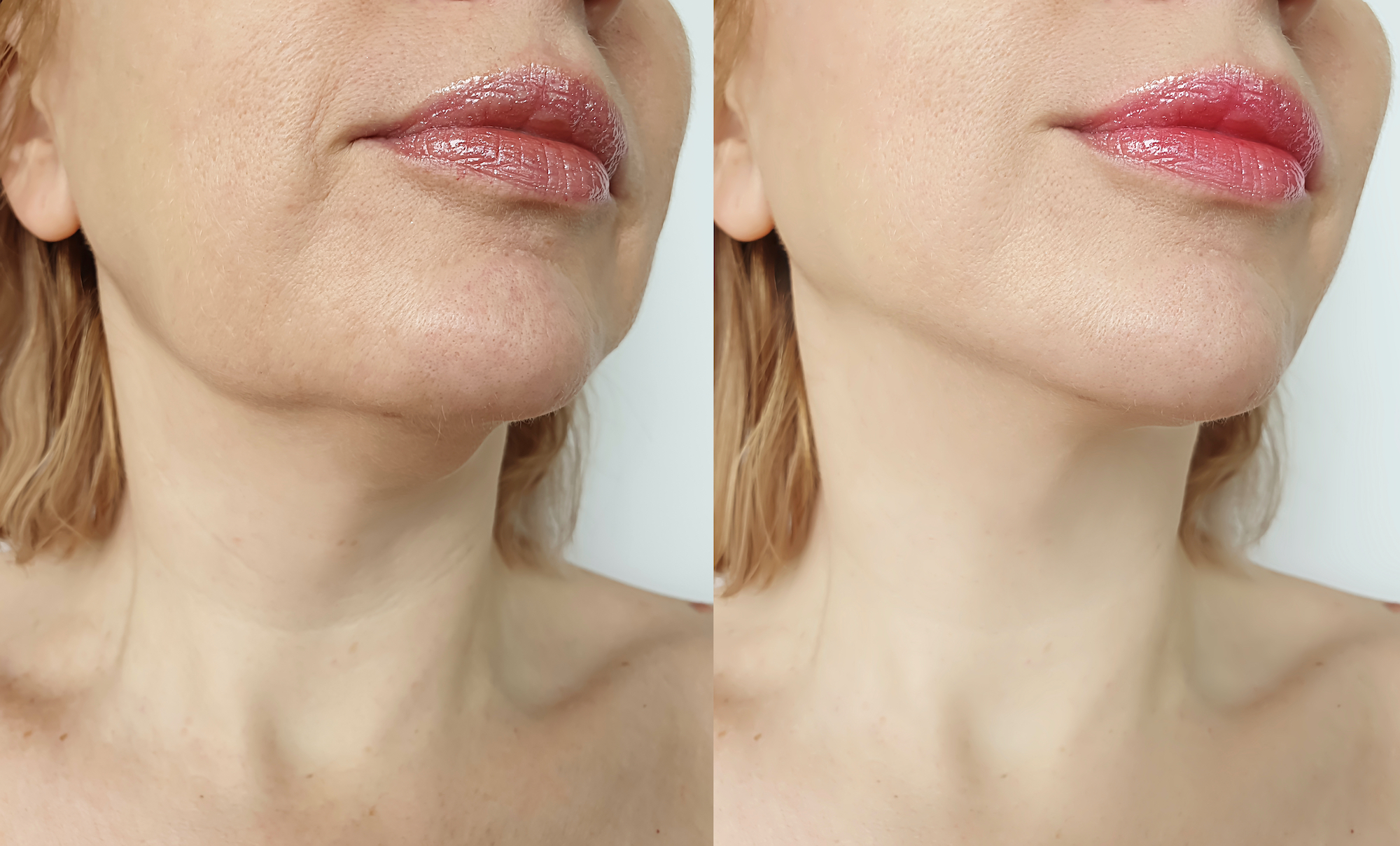 Before-After-Neck-Lift-Stock-Photo