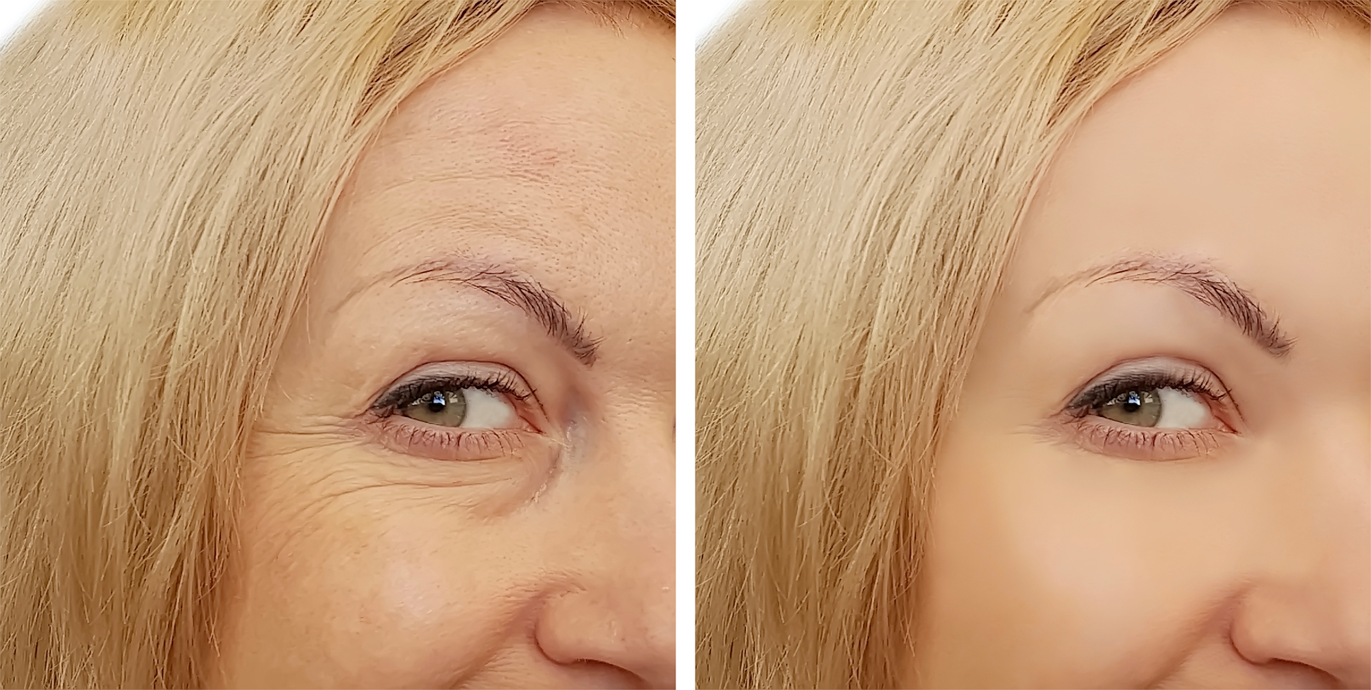 Before-After-Beauty-Wrinkle-Stock-Photo