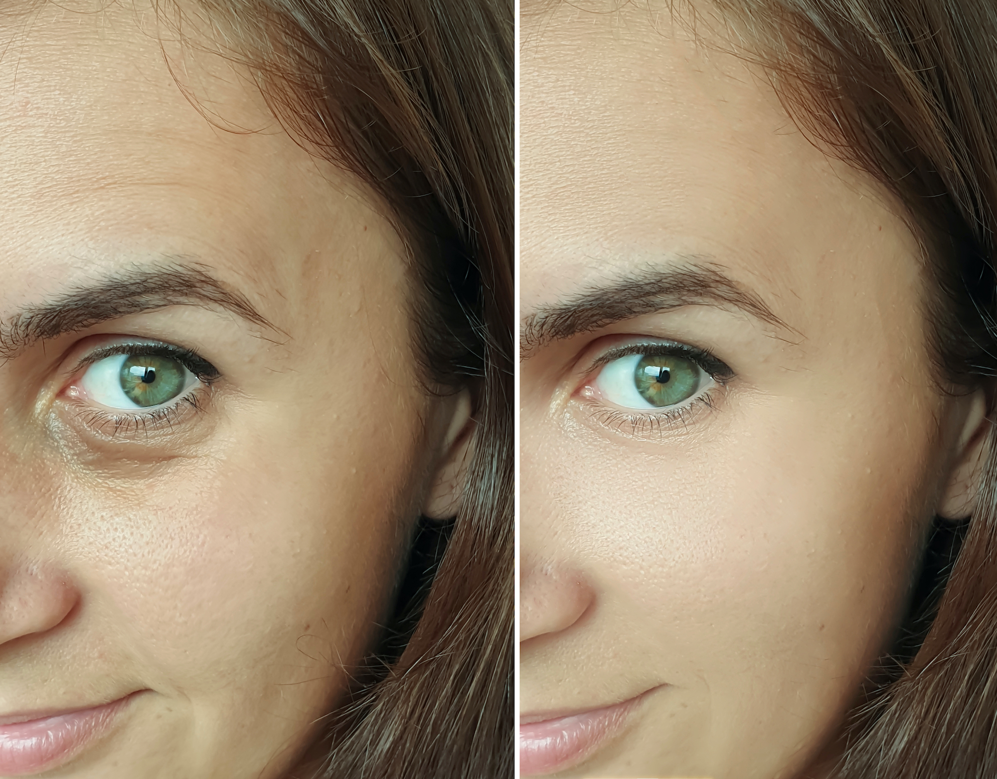 Before-After-Wrinkle-Treatment-Stock-Photo