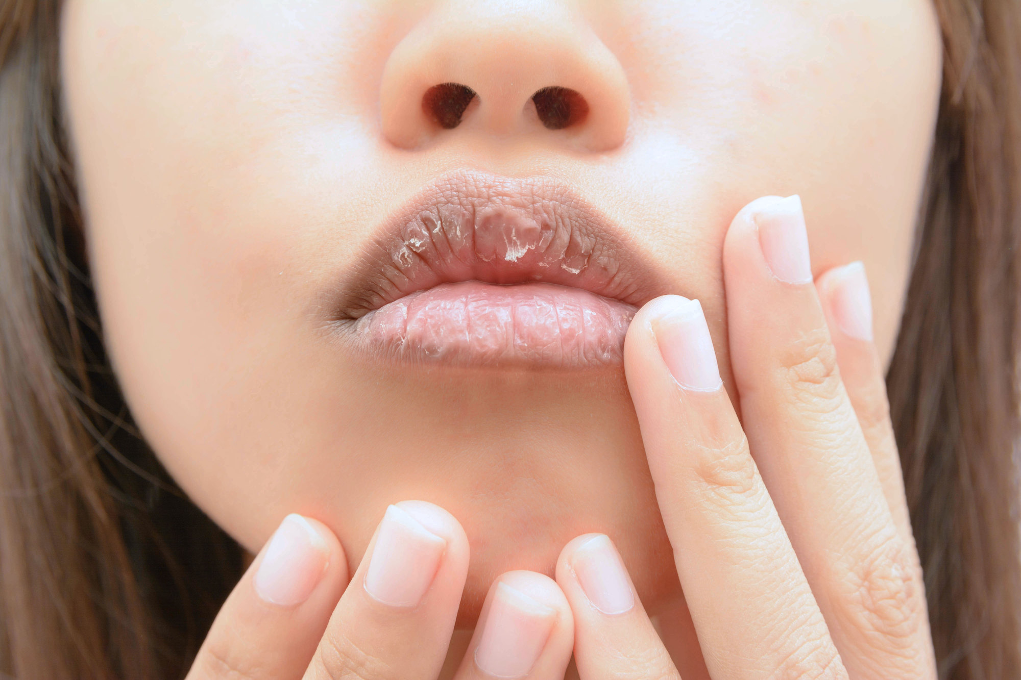 Chapped-Lips-Stock-Photo