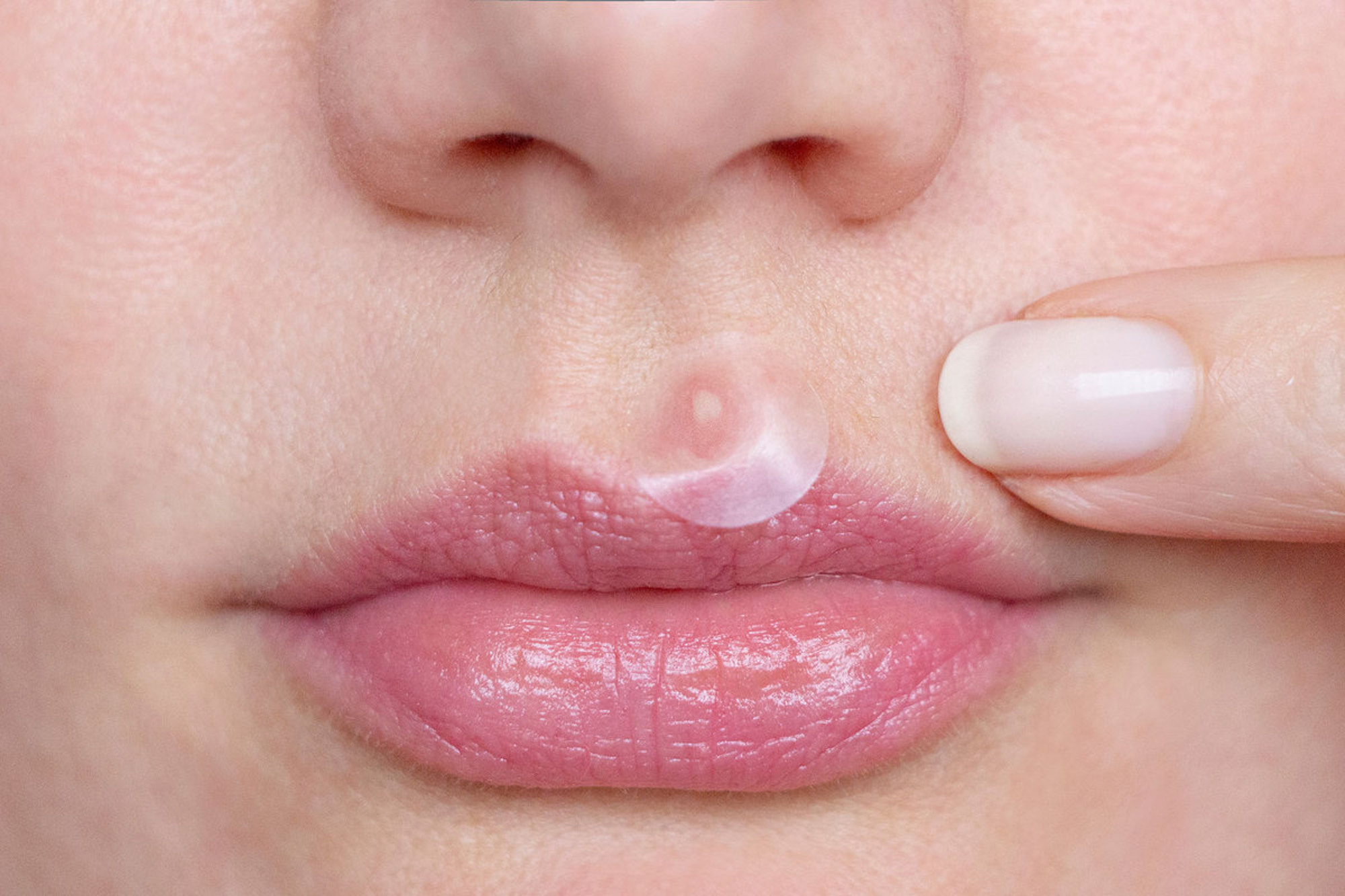 No-1-Best-Selling-Pimple-Patch-gets-rid-zits-little-6-hours-001