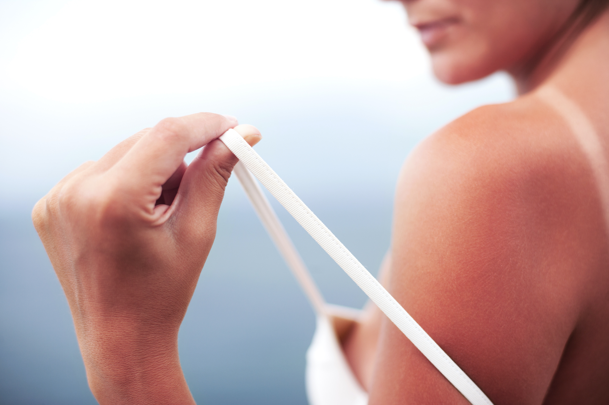 Sunburt-Skin-Stock-Photo