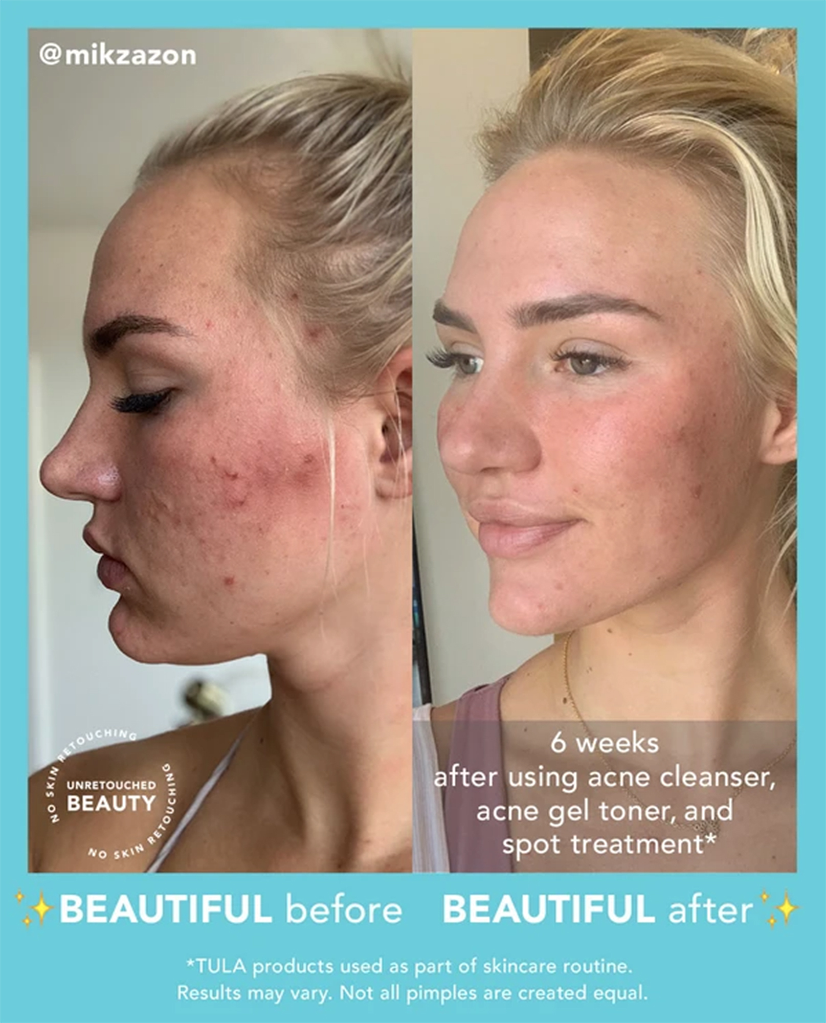 tula-skincare-acne-gel