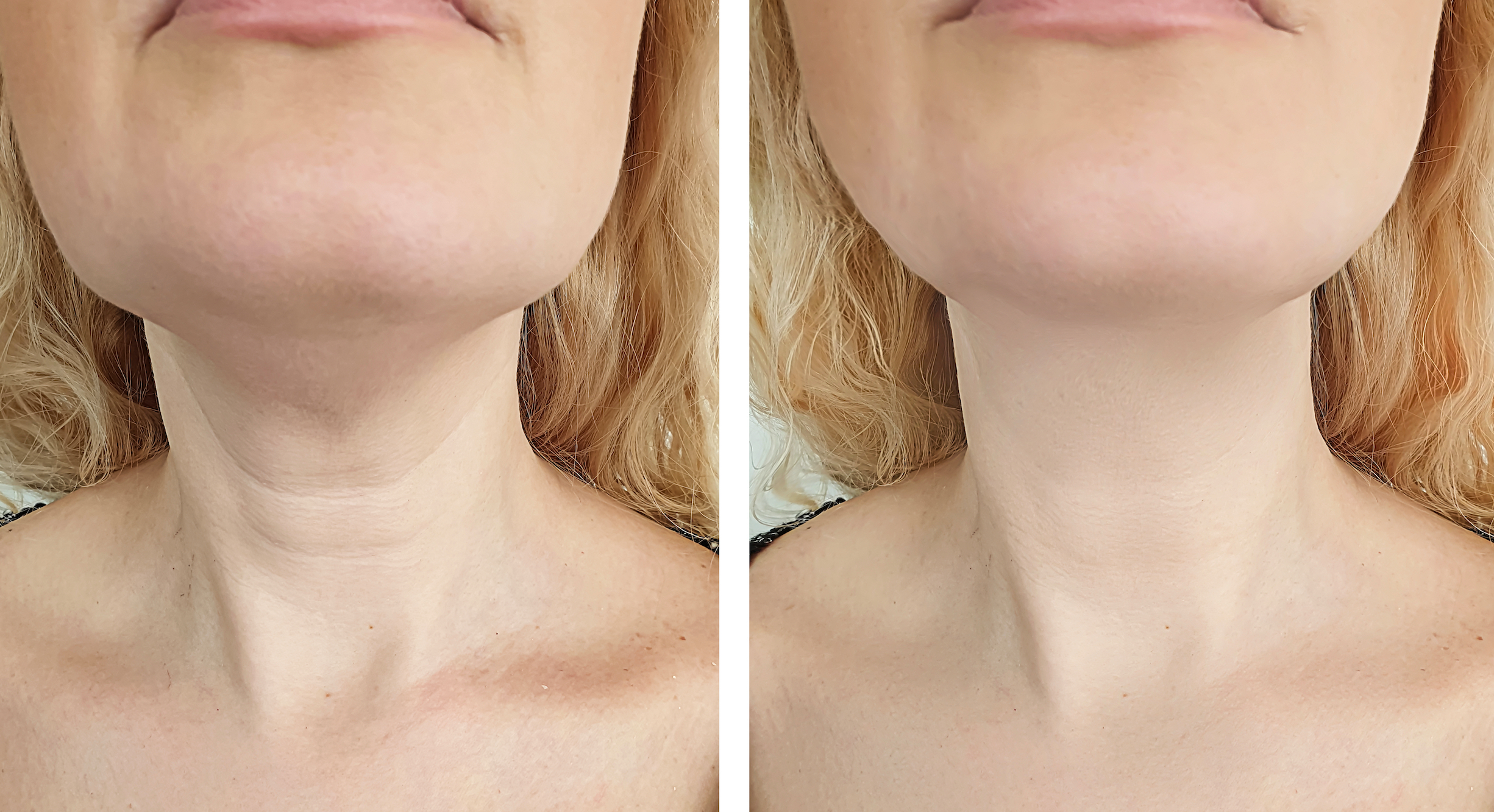 Neck-Lift-Before-After
