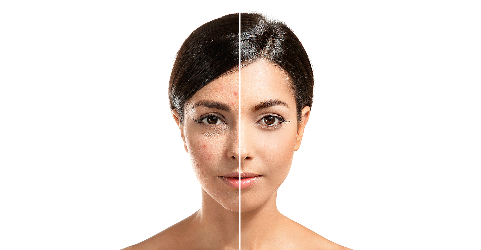 acne-elixir-pimple-before-after