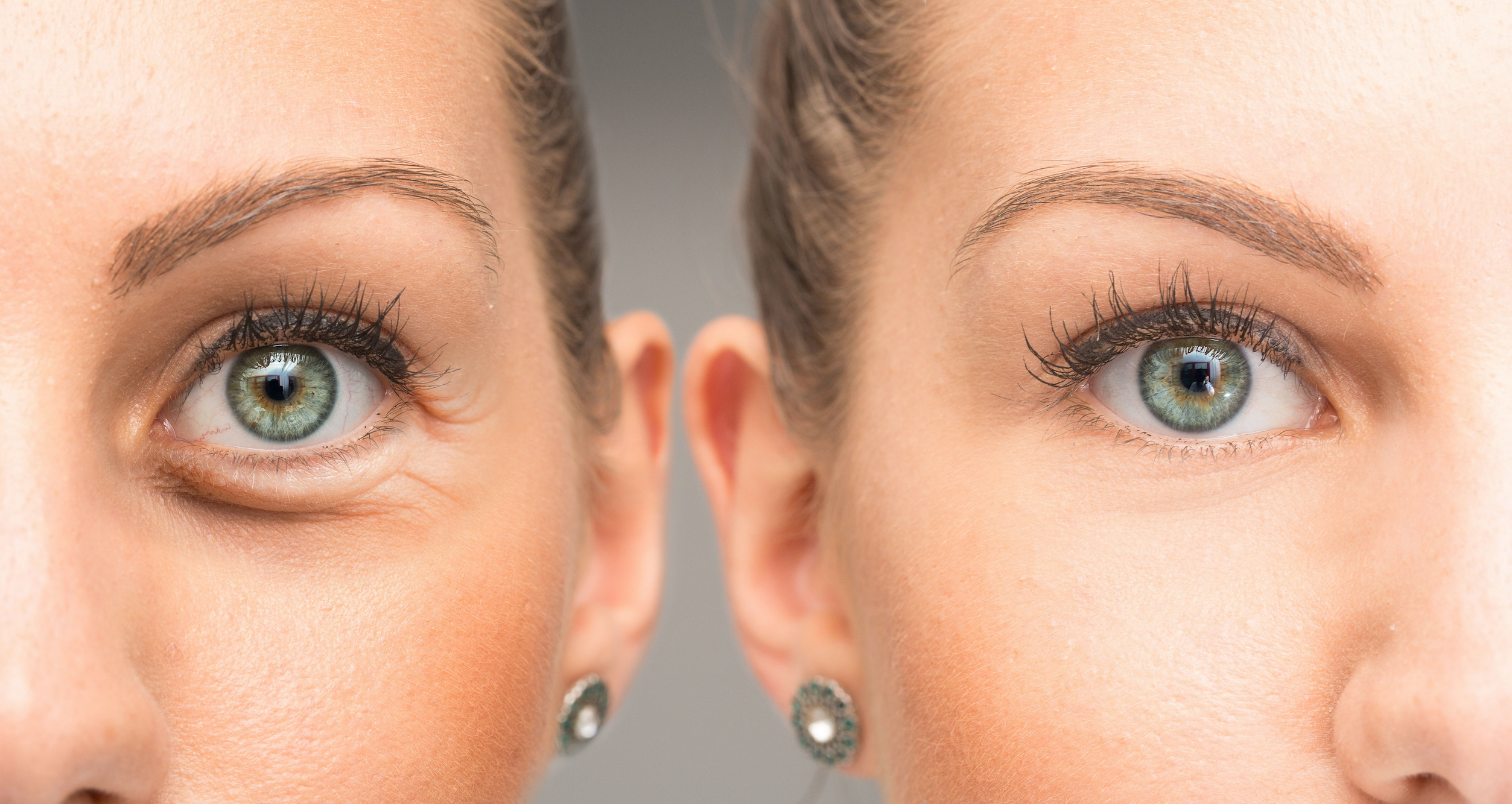 Undereye-Bags