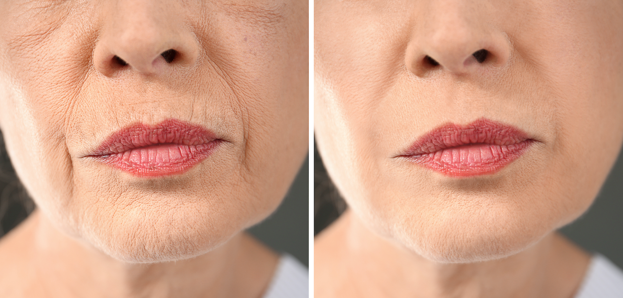 Upper-Lip-Treatment