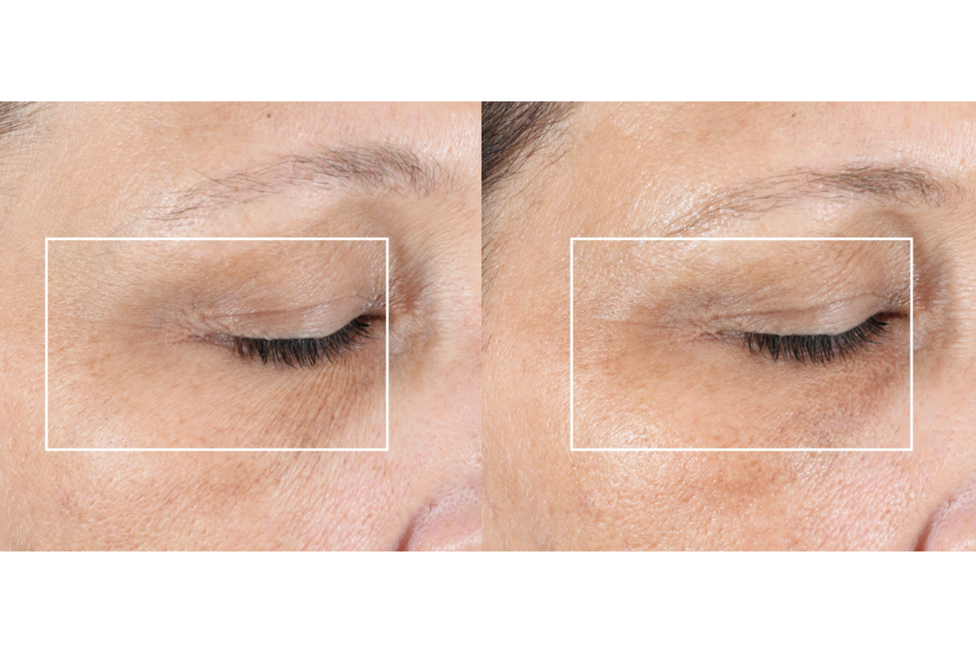 NuFACE FIX® Line Smoothing Device Kit