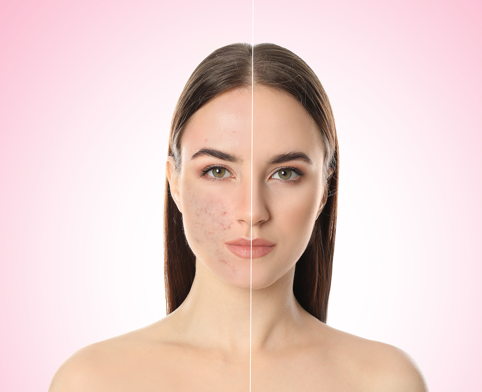 lightstim-acne-before-after