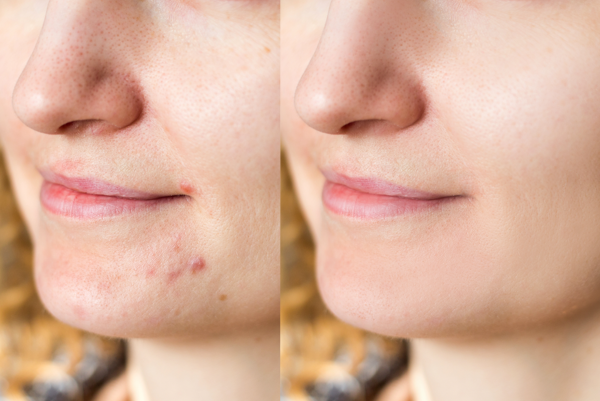 Before-After-Acne-Scarring-Stock-Photo