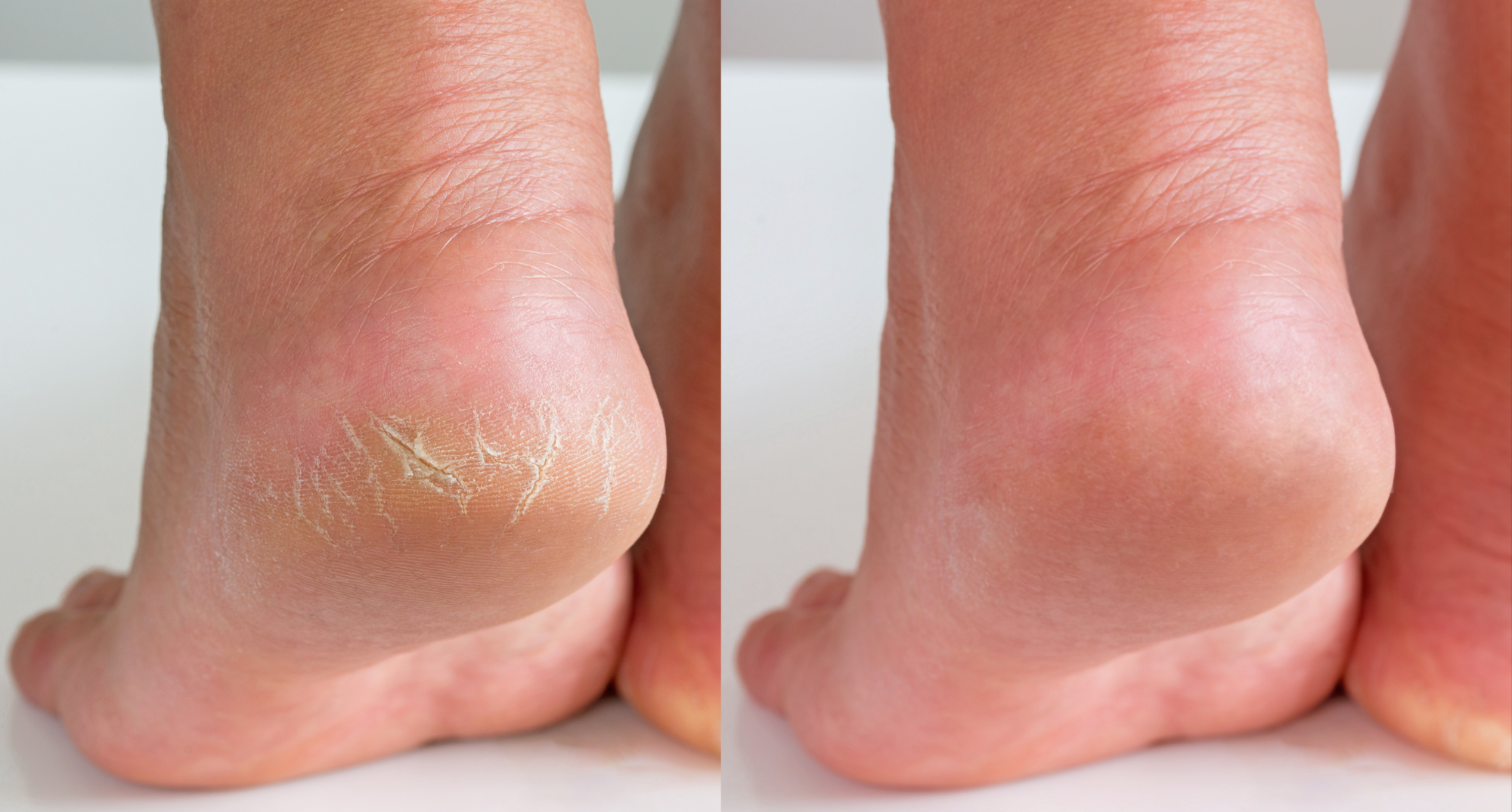 Cracked-Feet-Before-After