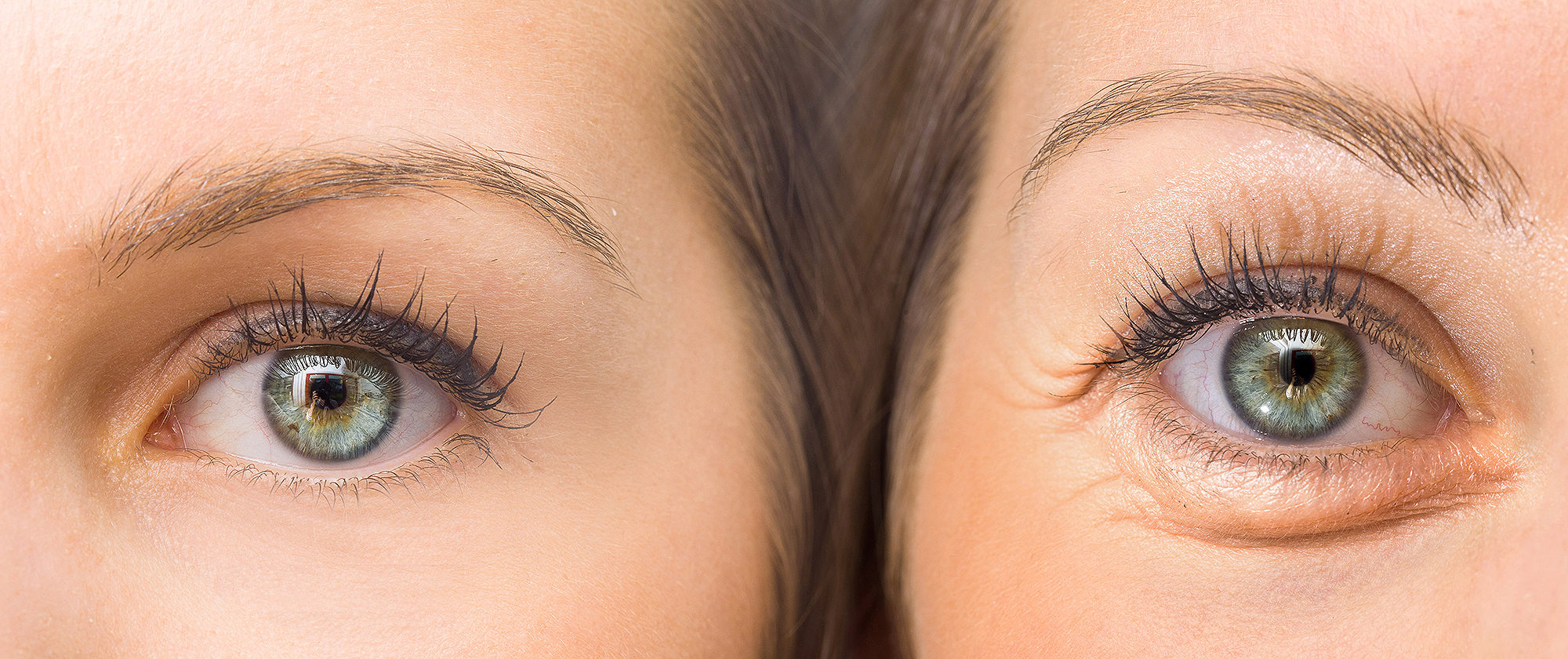 crows-feet-before-after