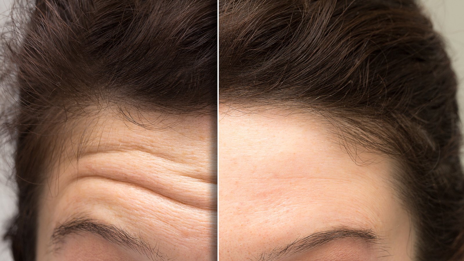 forehead-wrinkle-creams