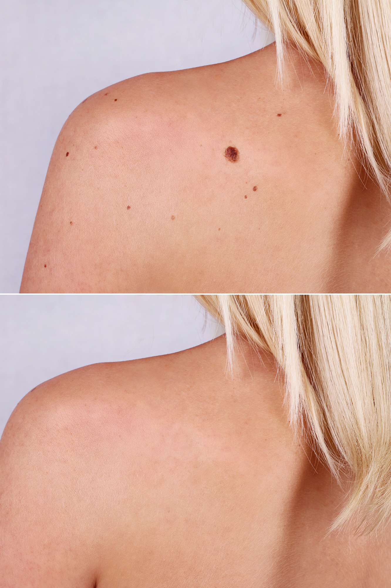 skin-tag-remover-amazon