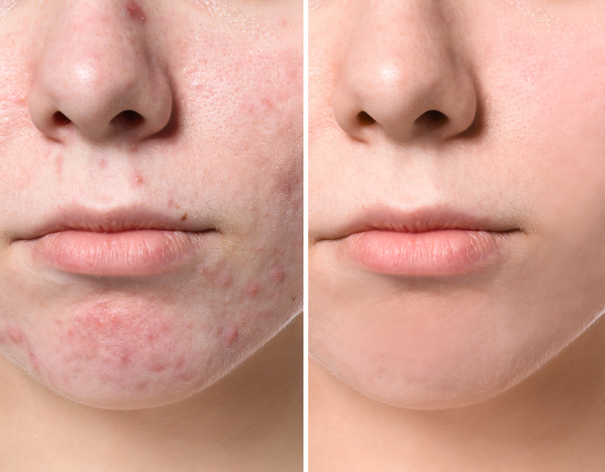 acne-before-after