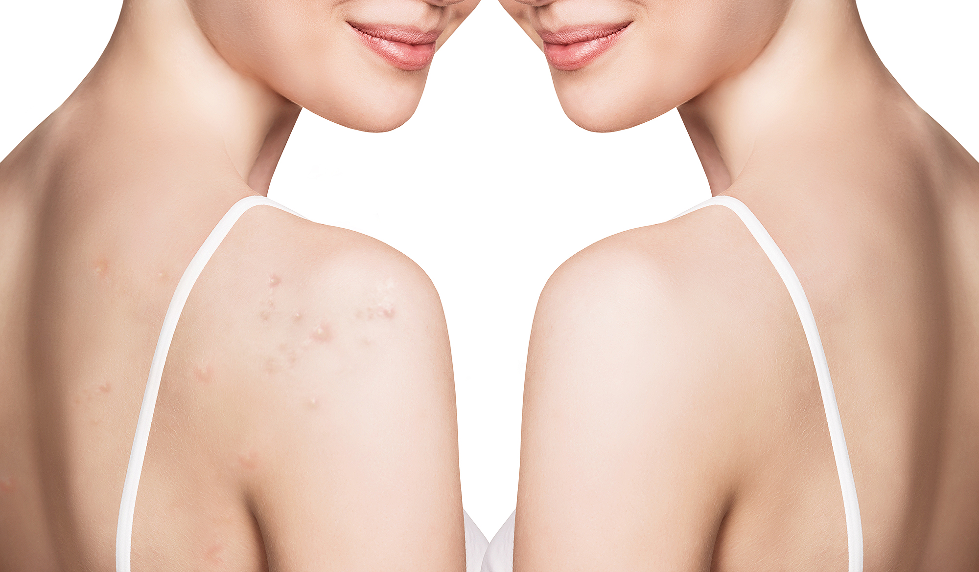 paulas-choice-acne-body-spray-backne