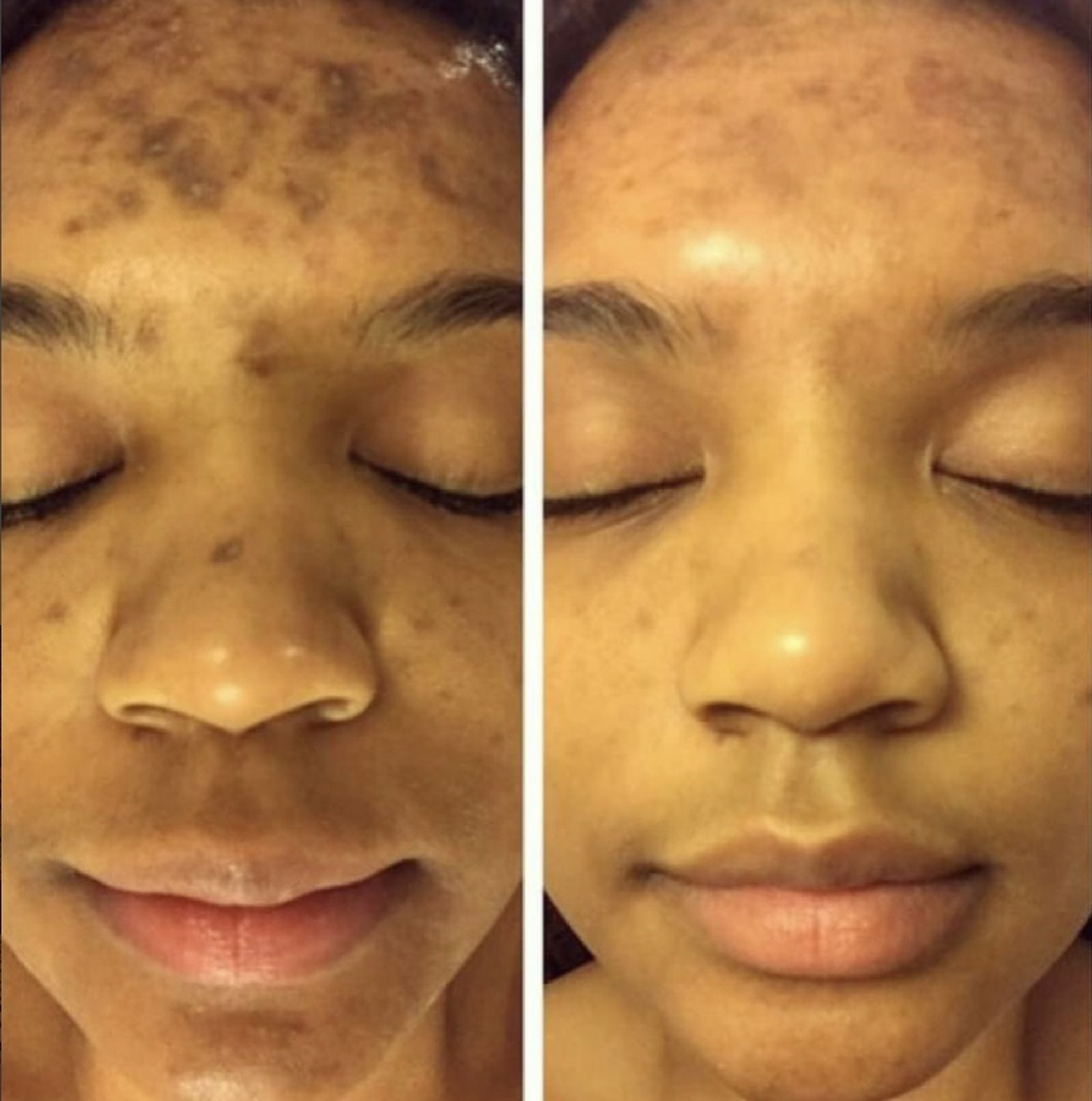 admire-my-skin-dark-spot-corrector