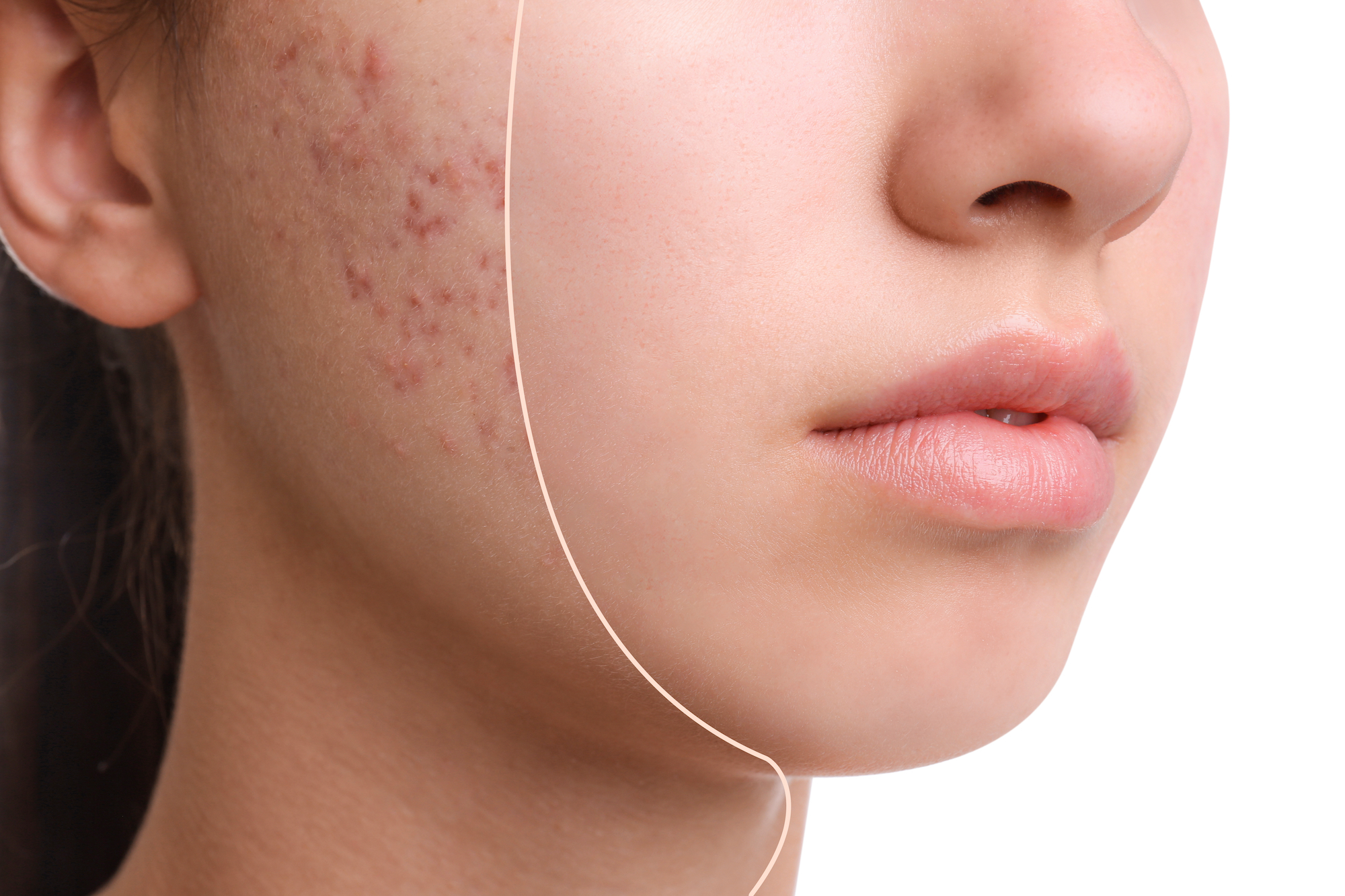Before-After-Acne-Spot-Treatment-Stock-Photo