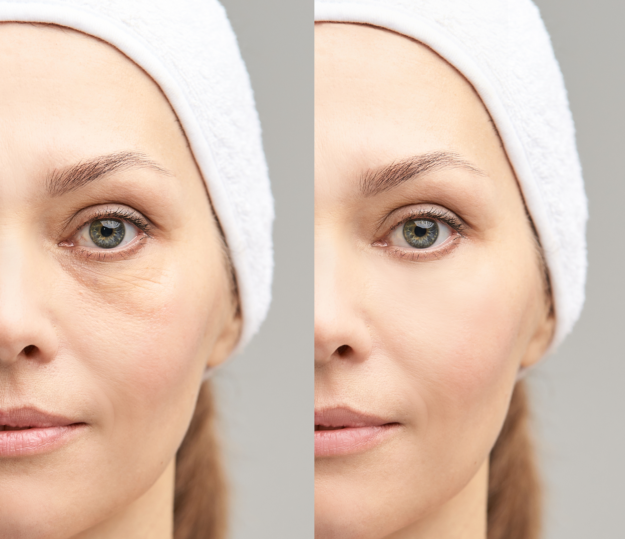 Before-After-Eye-Lift-Treatment-Stock-Photo