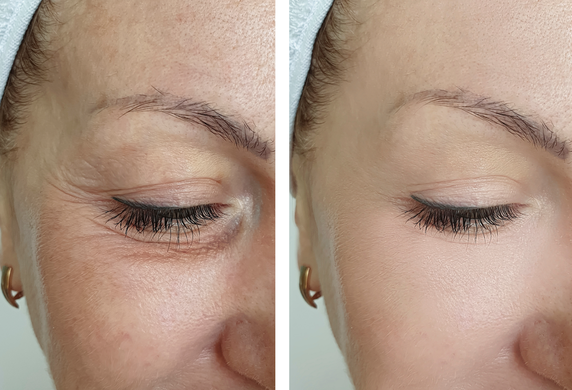 Upper-Eye-Lift-Treatment-Stock-Photo