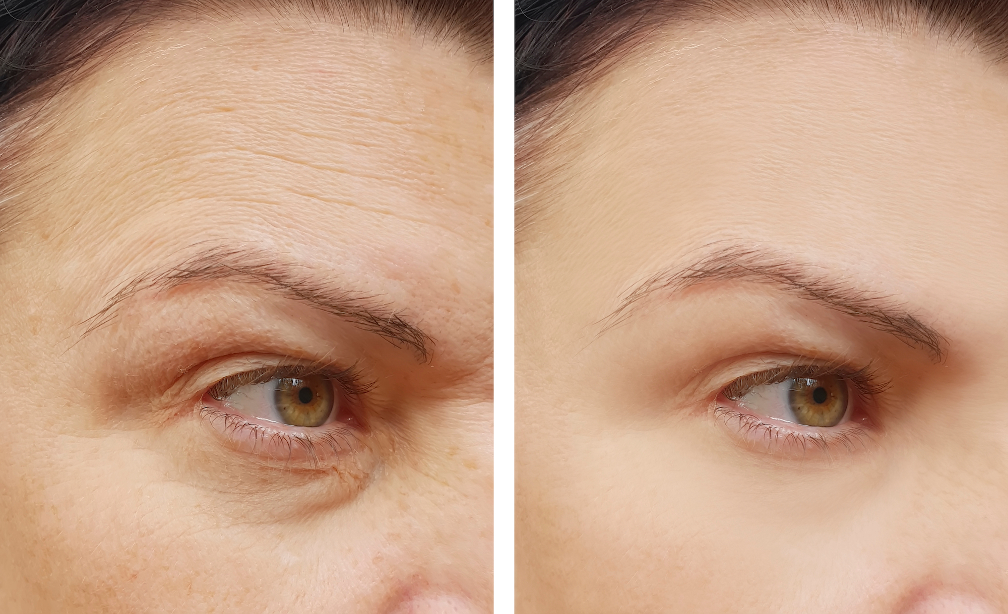 Wrinkles-Before-After-Stock-Photo
