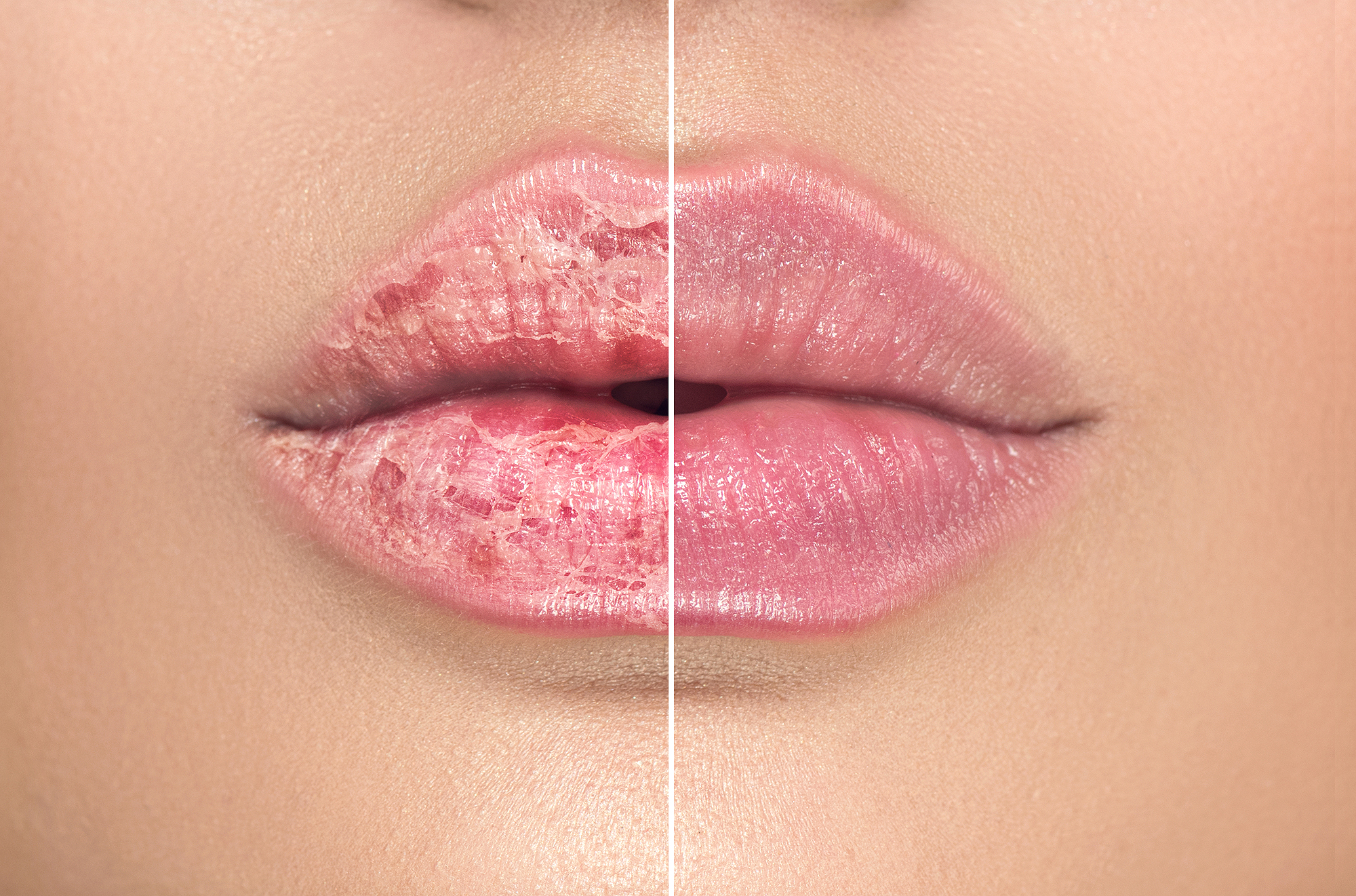 chapped-lips-before-after