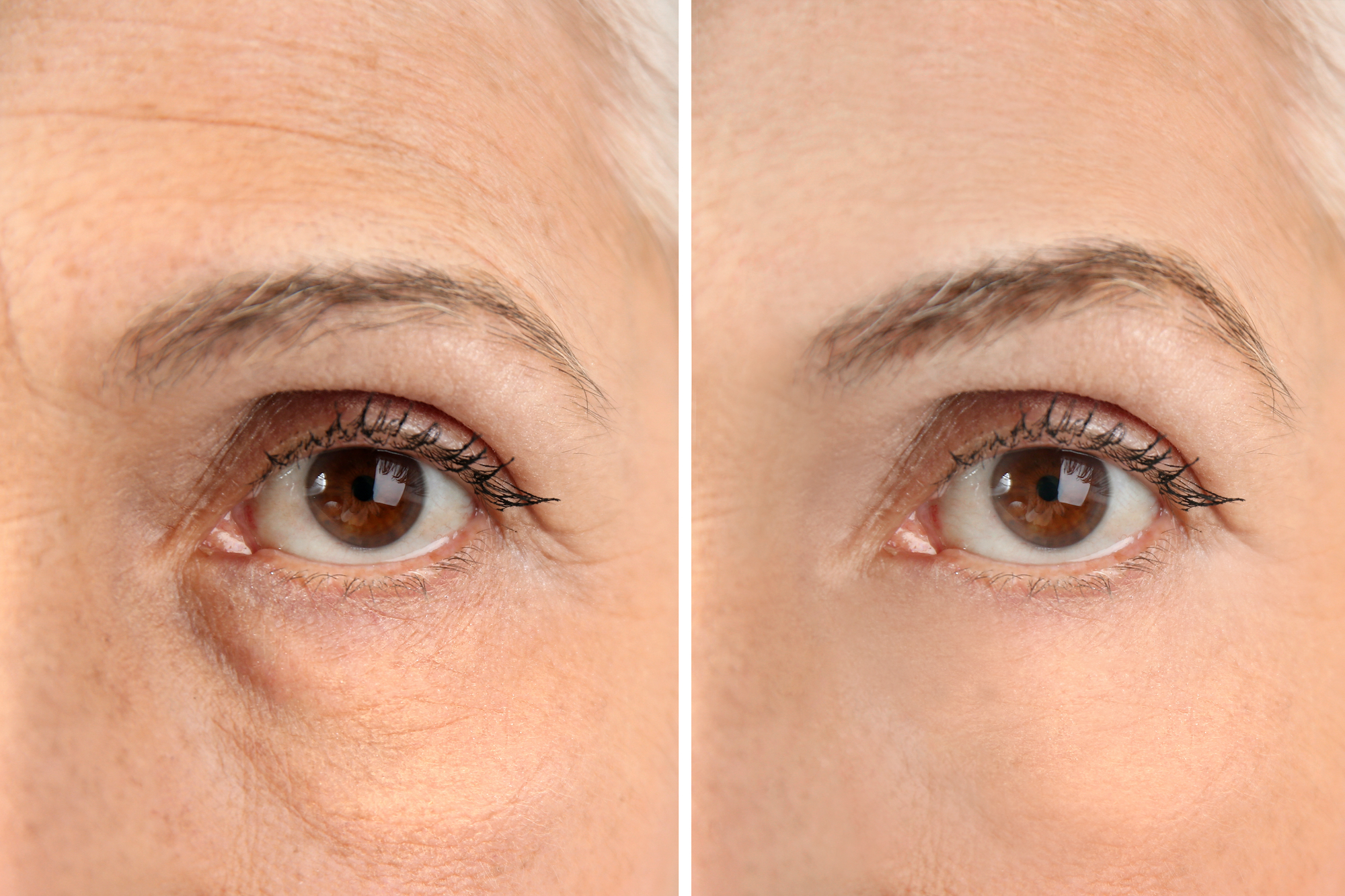 Before-After-Eye-Serum-Stock-Photo