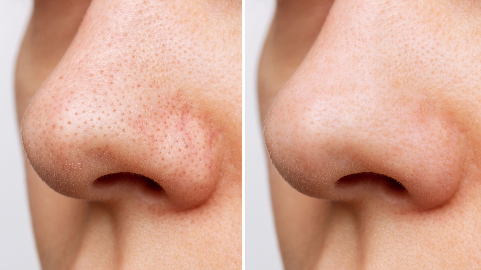 Pore-Trestment-Before-After-Stock-Photo