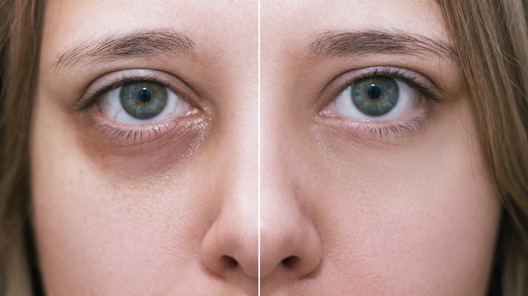 Dark-Circle-Before-After-Stock-Photo