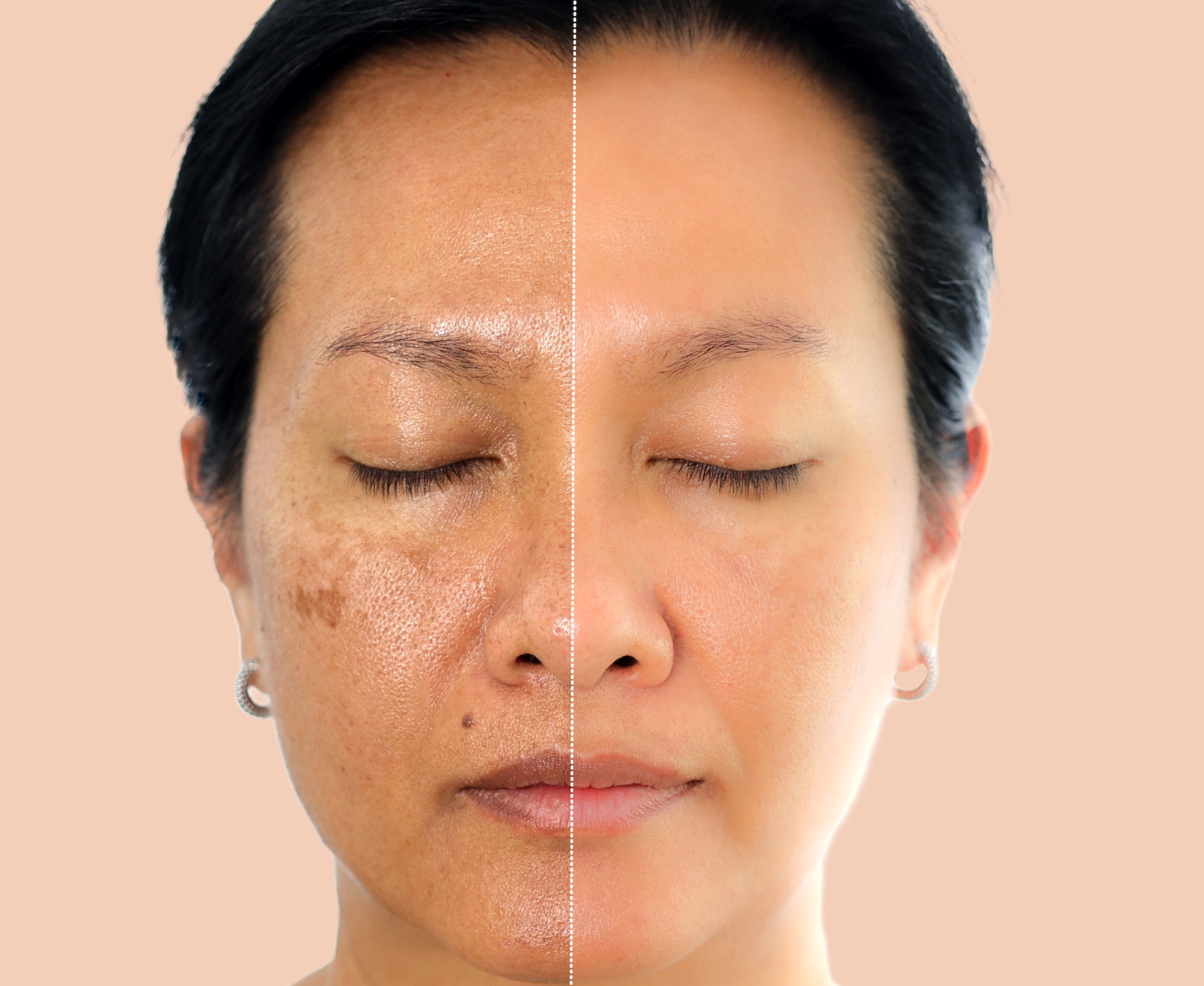 Dark-Spot-Before-After-Stock-Photo