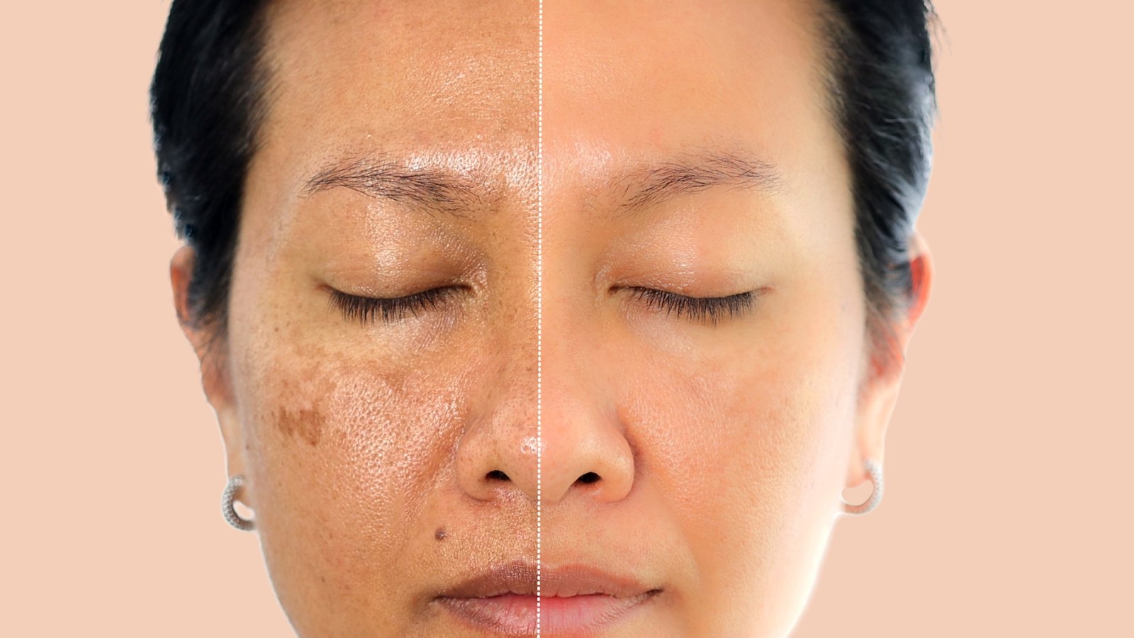 Dark-Spot-Before-After-Stock-Photo