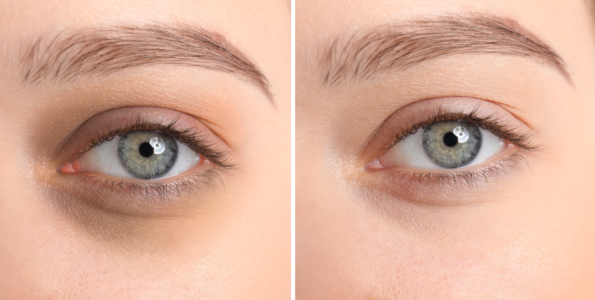 Before-After-Dark-Circle-Stock-Photo