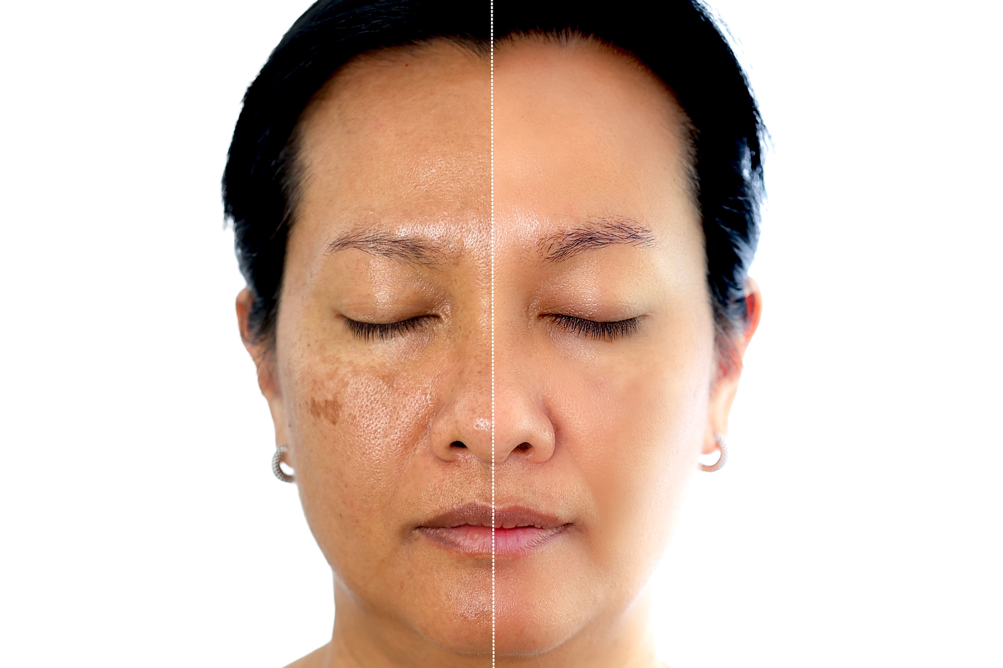 Skin-Discoloration-Before-After-Stock-Photo