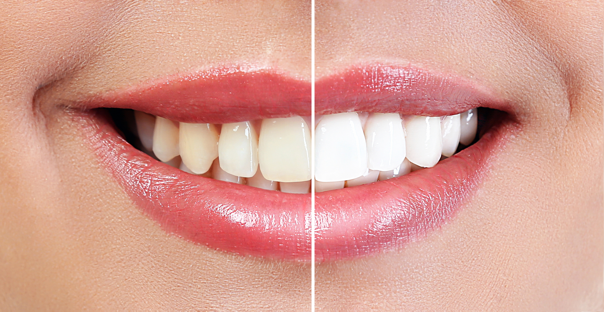 White-Teeth-Before-After-Stock-Photo