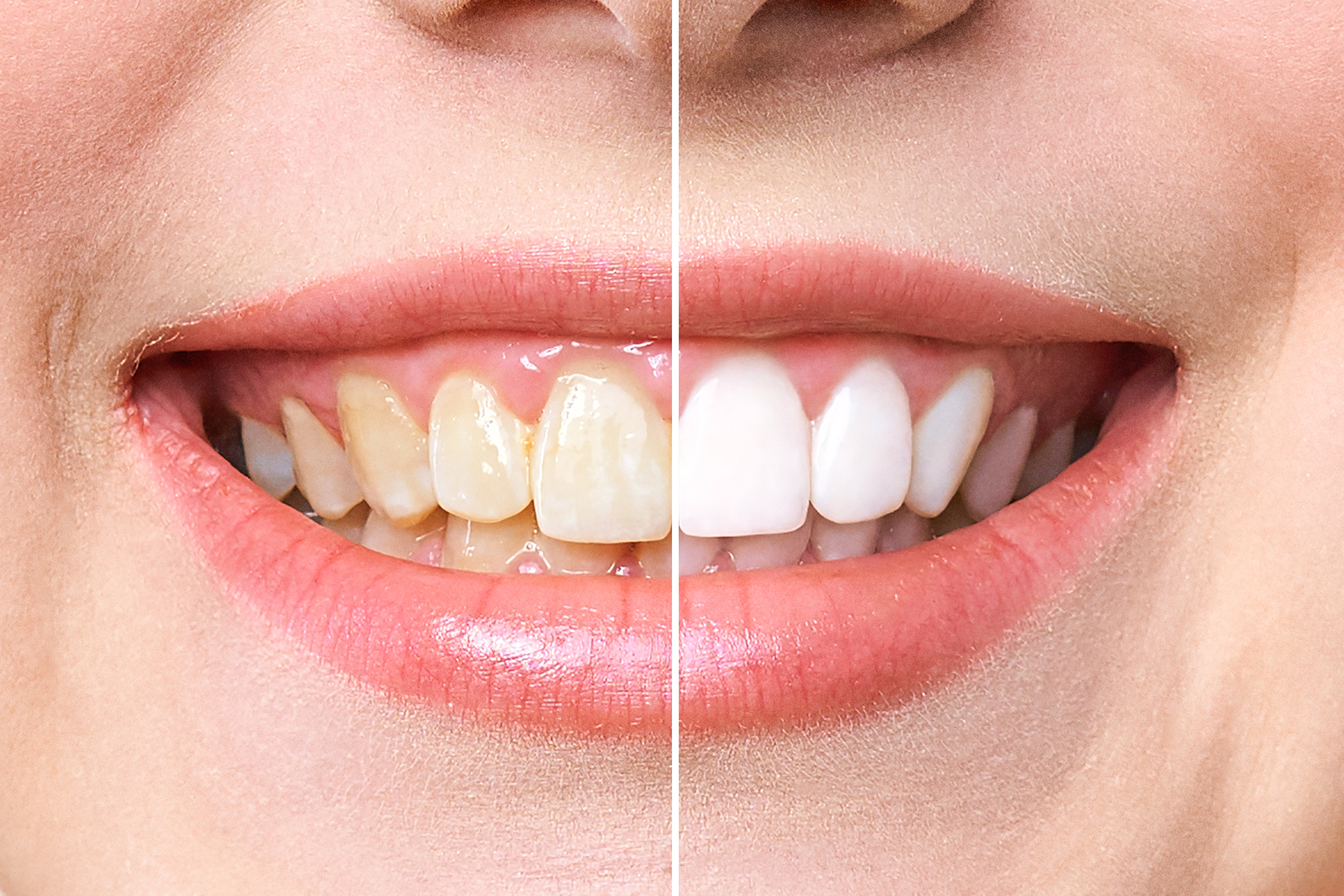 amazon-teeth-whitening-deals