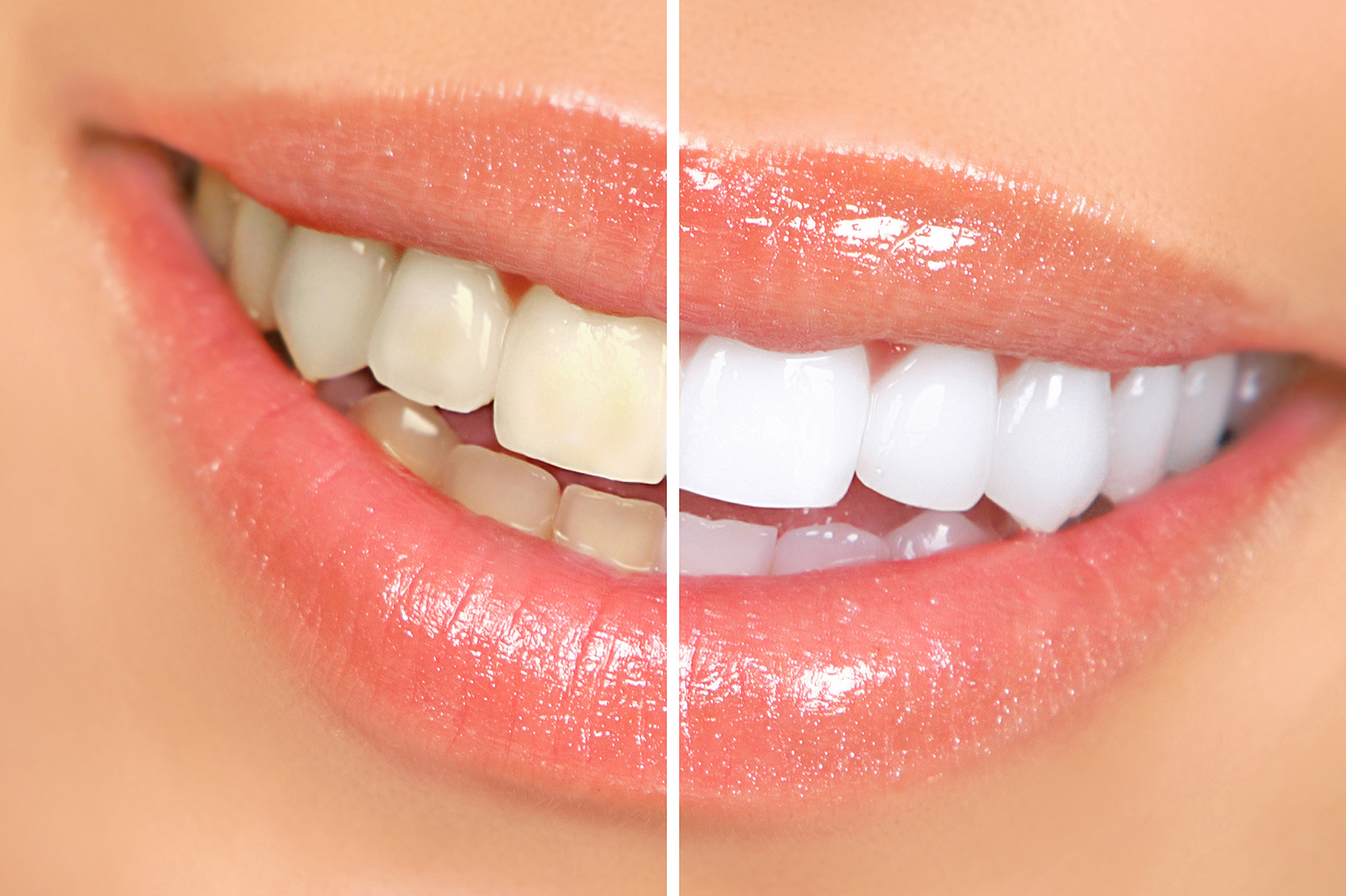 amazon-lumineaux-teeth-whitening-bright-pen