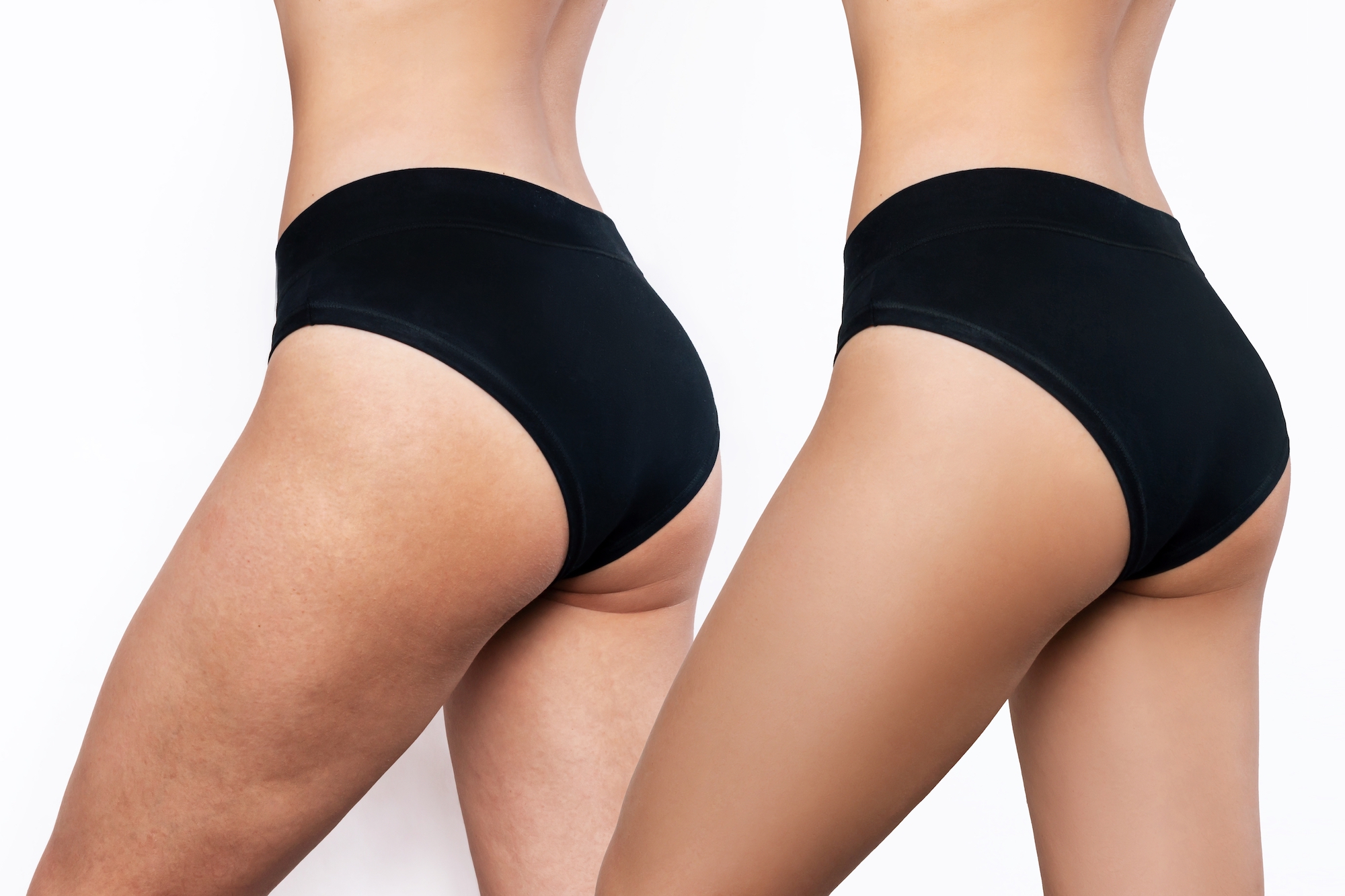Best-Anti-Cellulite-Cream-Stock-Photo