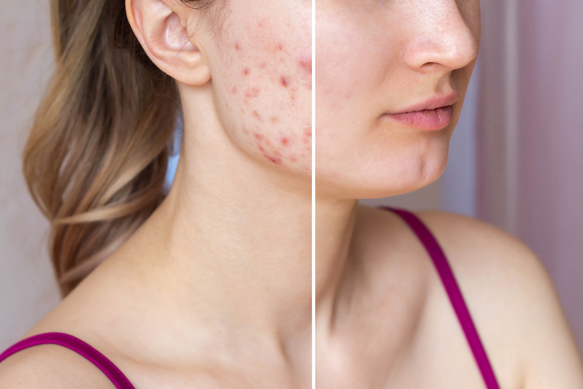 before-after-adult-acne