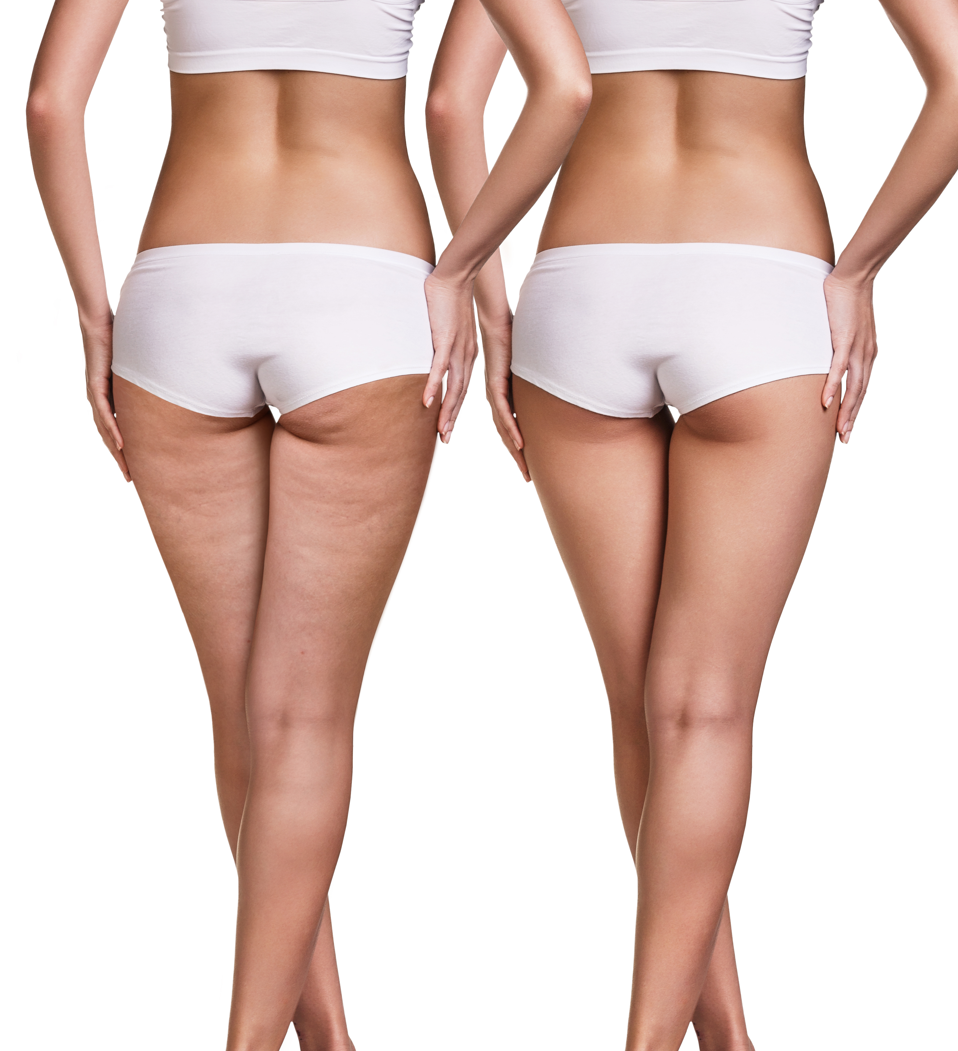 cellulite before and after
