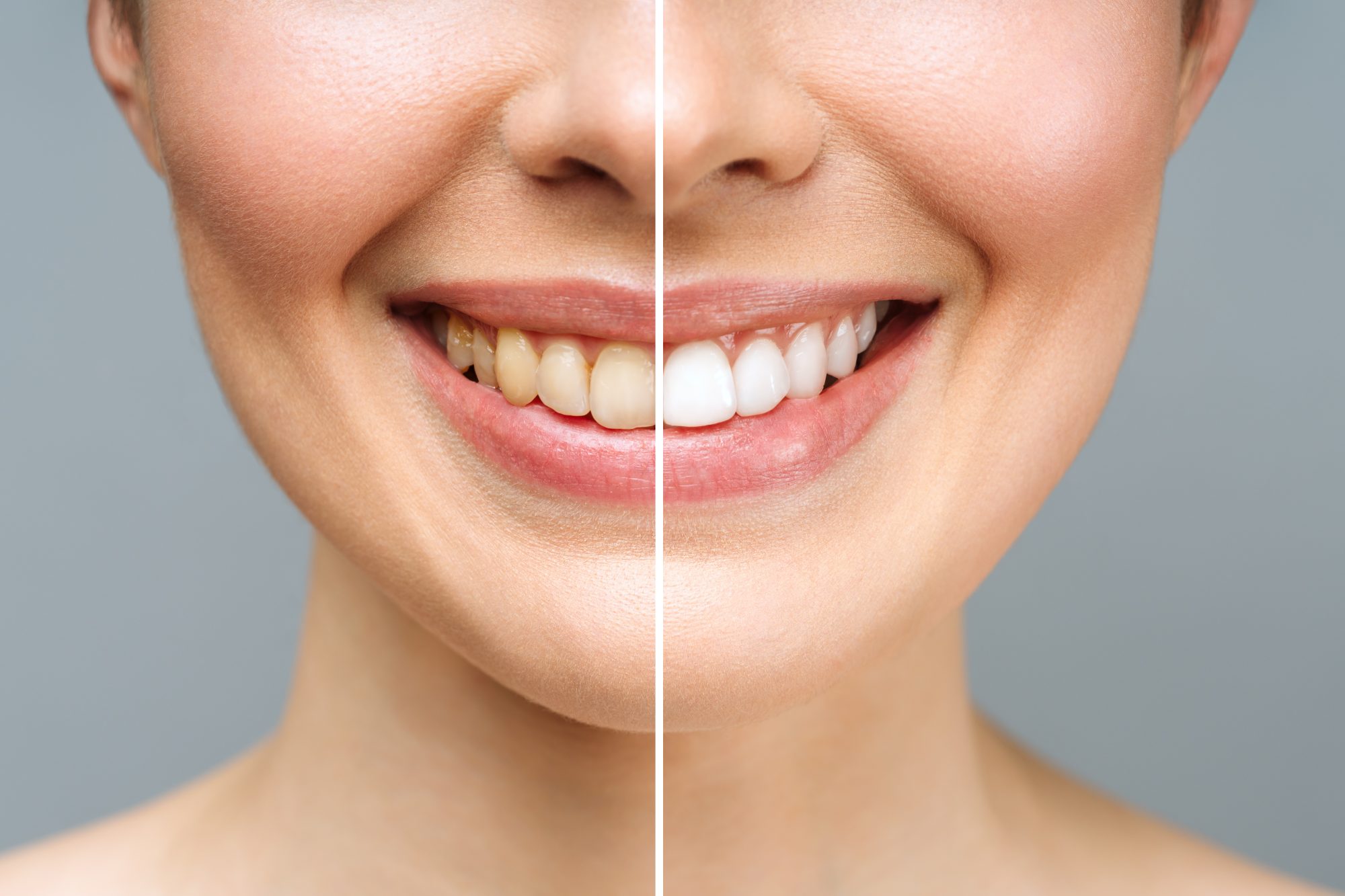 teeth whitening deals