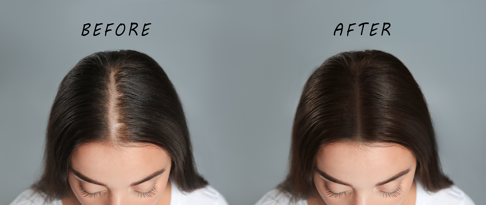 Woman with hair loss problem before and after treatment on grey background, collage. Visiting trichologist