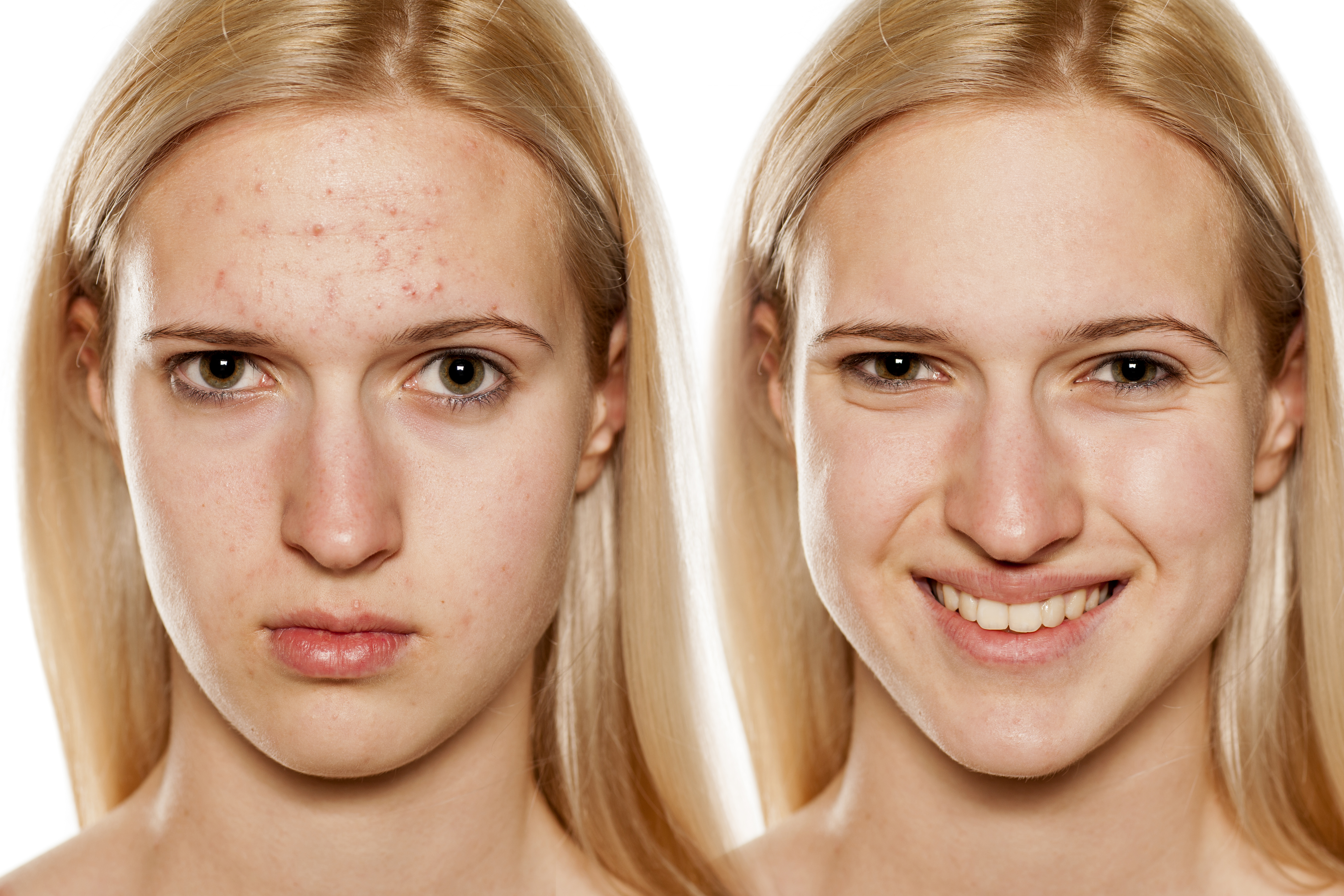 hormonal acne before and after