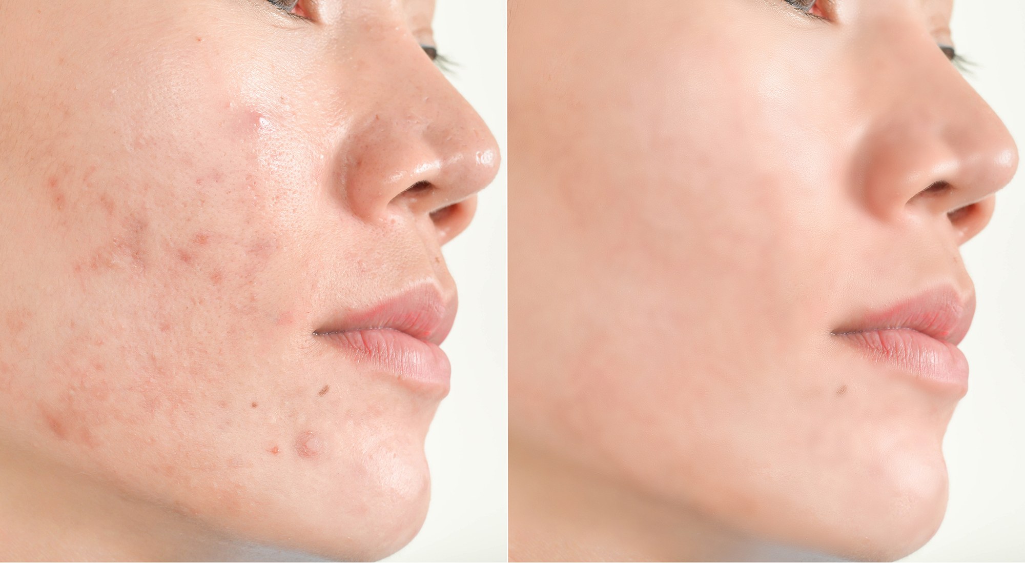 Acne scars and pores. Black spots, wrinkles and skin problems Facial Treatment Step