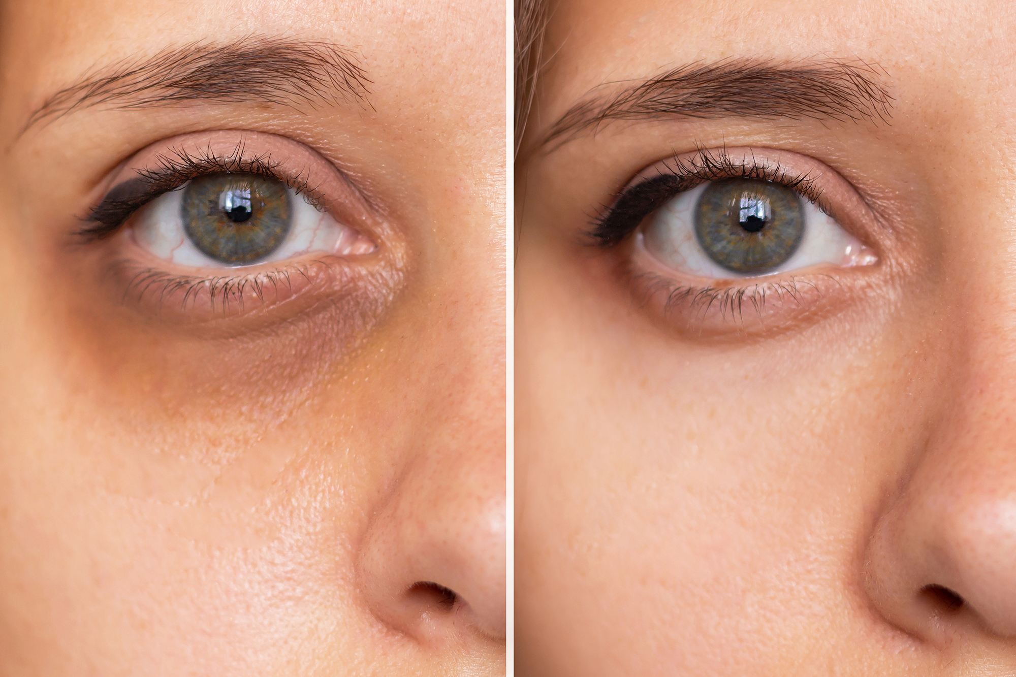 Cropped shot of a young woman's face with dark circles under eyes